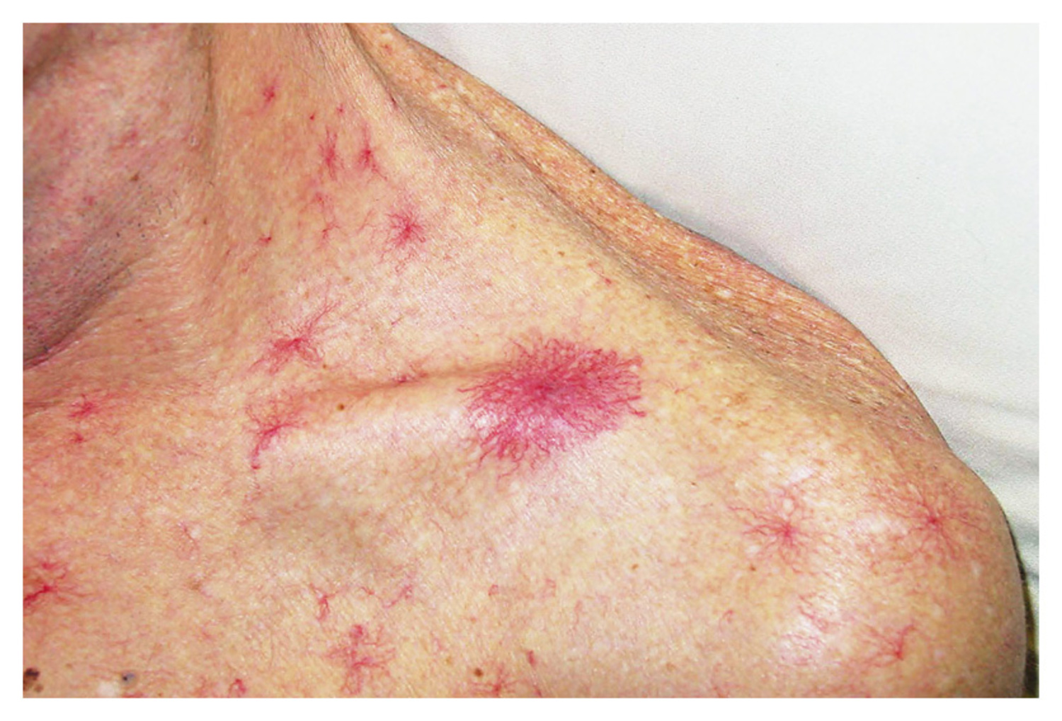 Spider angioma