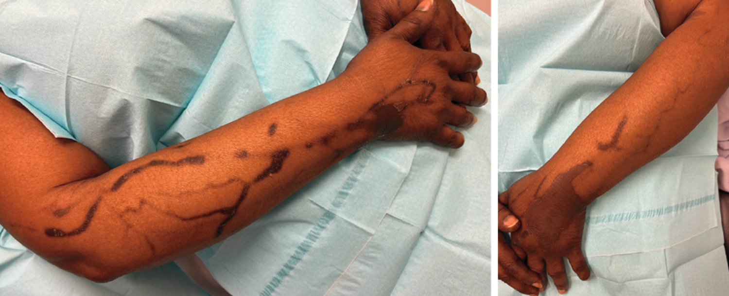 Serpentine supravenous hyperpigmentation