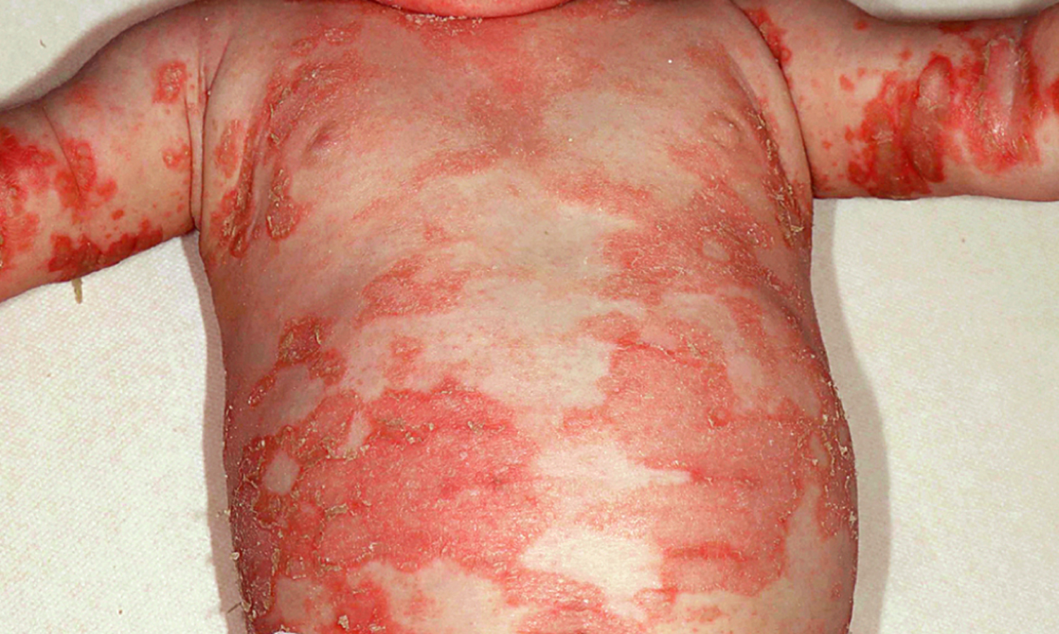 Zinc deficiency