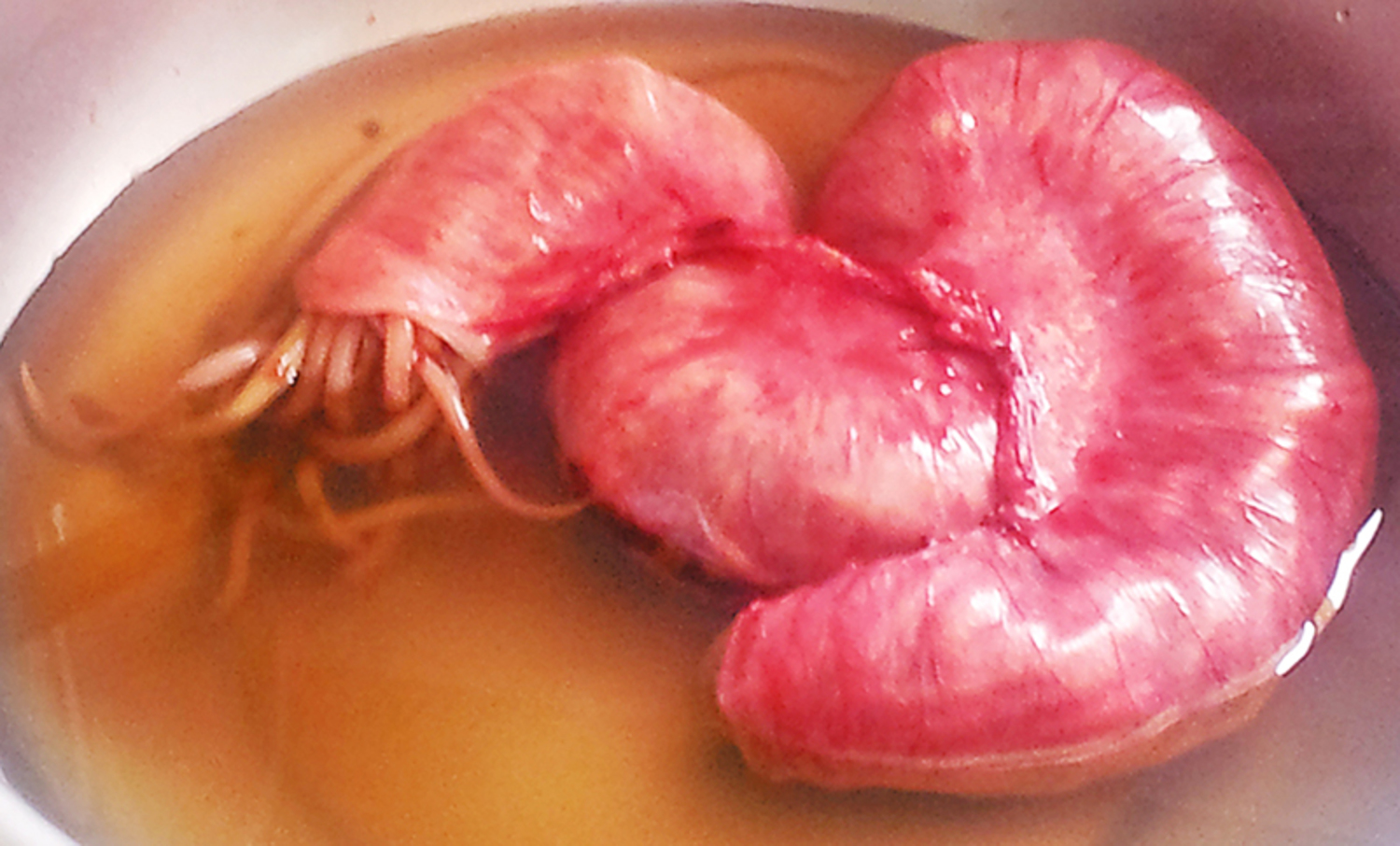 Ascariasis