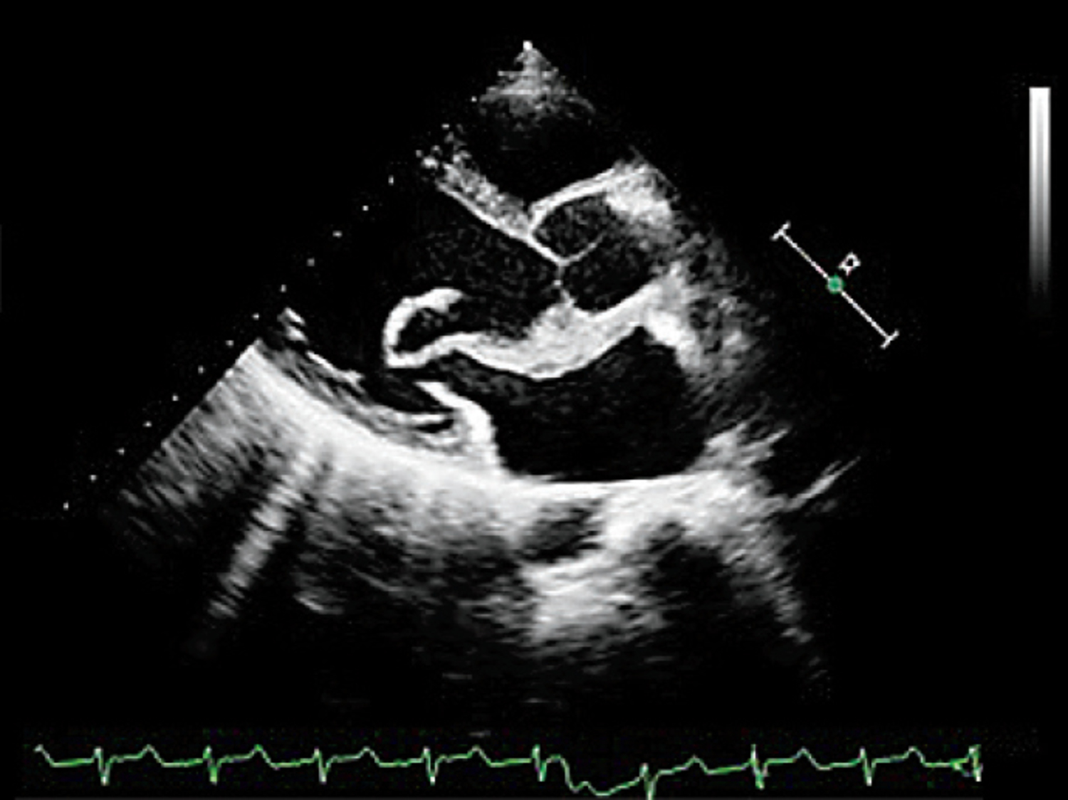 Redundant mitral valve