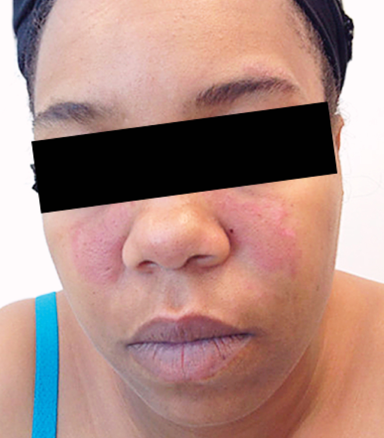 Systemic lupus erythematosus