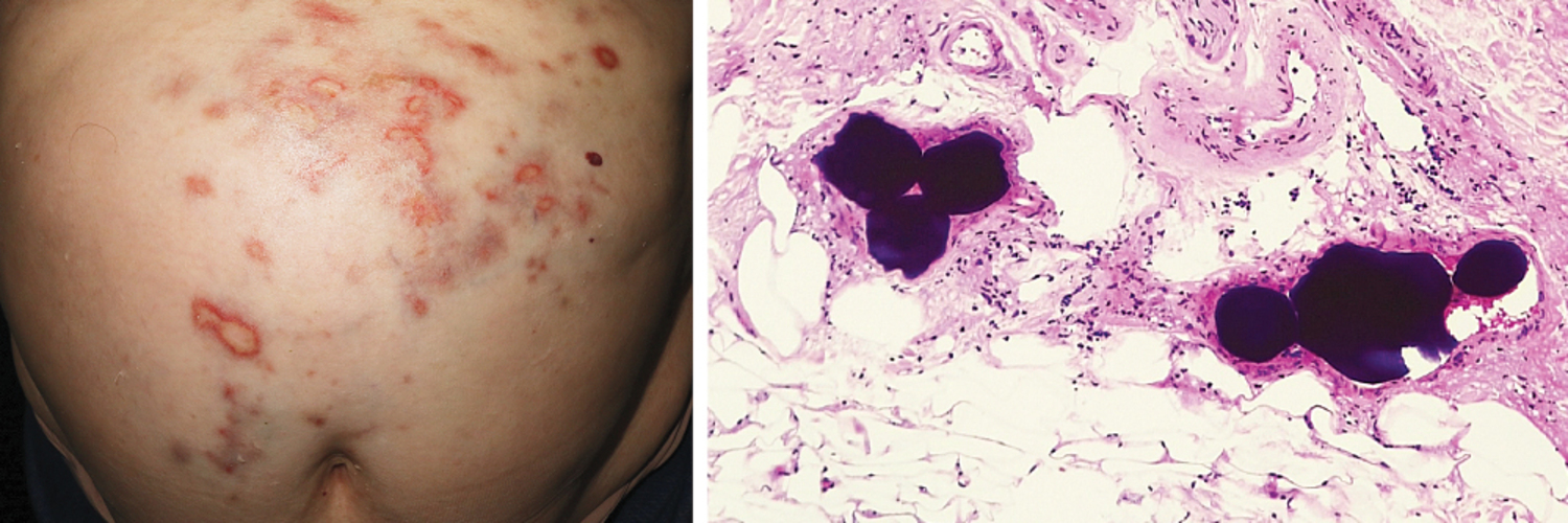 Drug-Eluting Bead Embolism