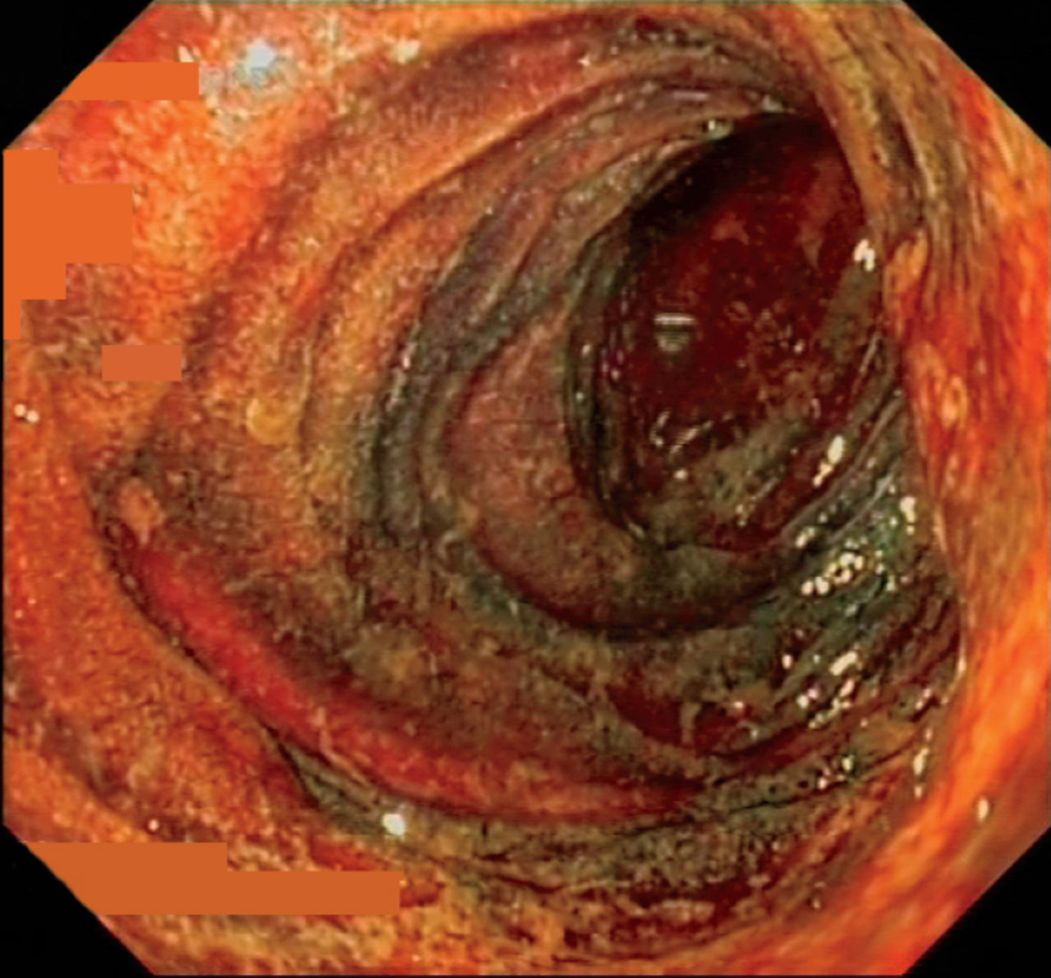 Acute mesenteric ischemia