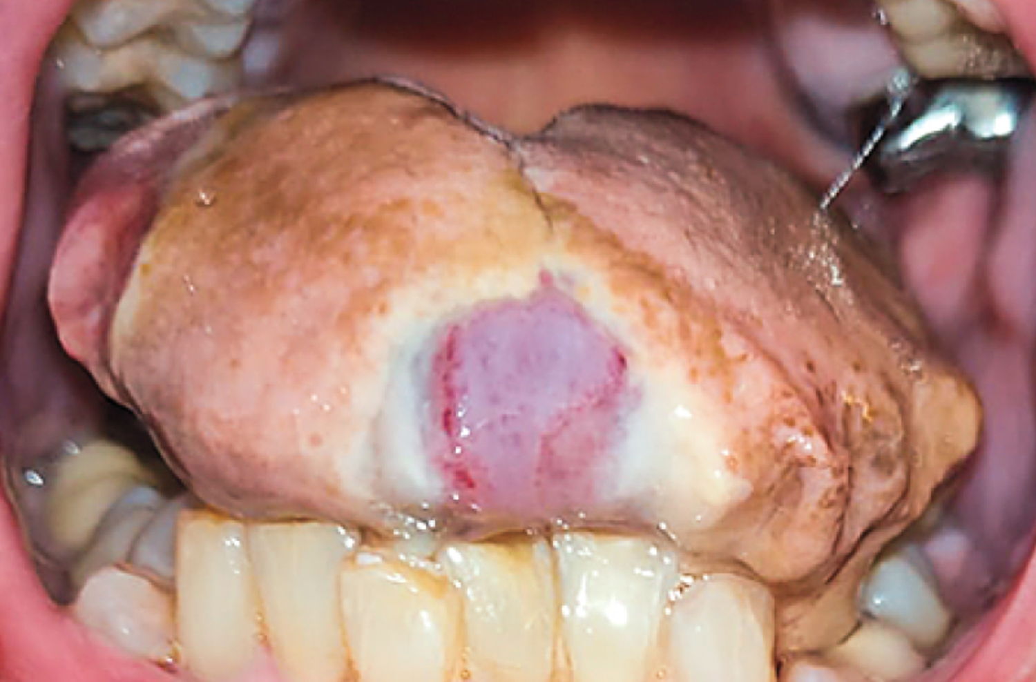 Giant-cell arteritis