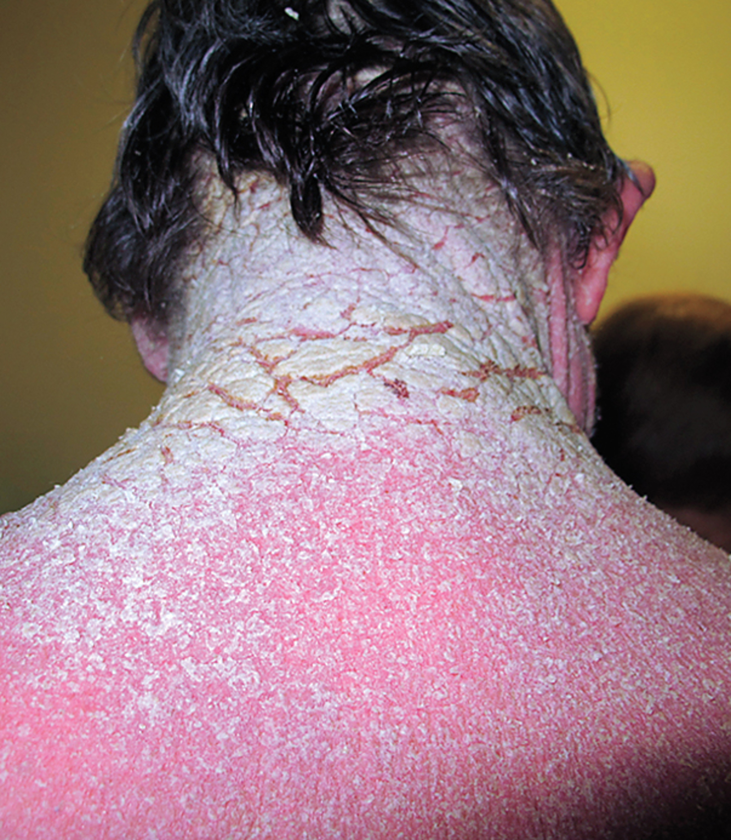 Crusted scabies
