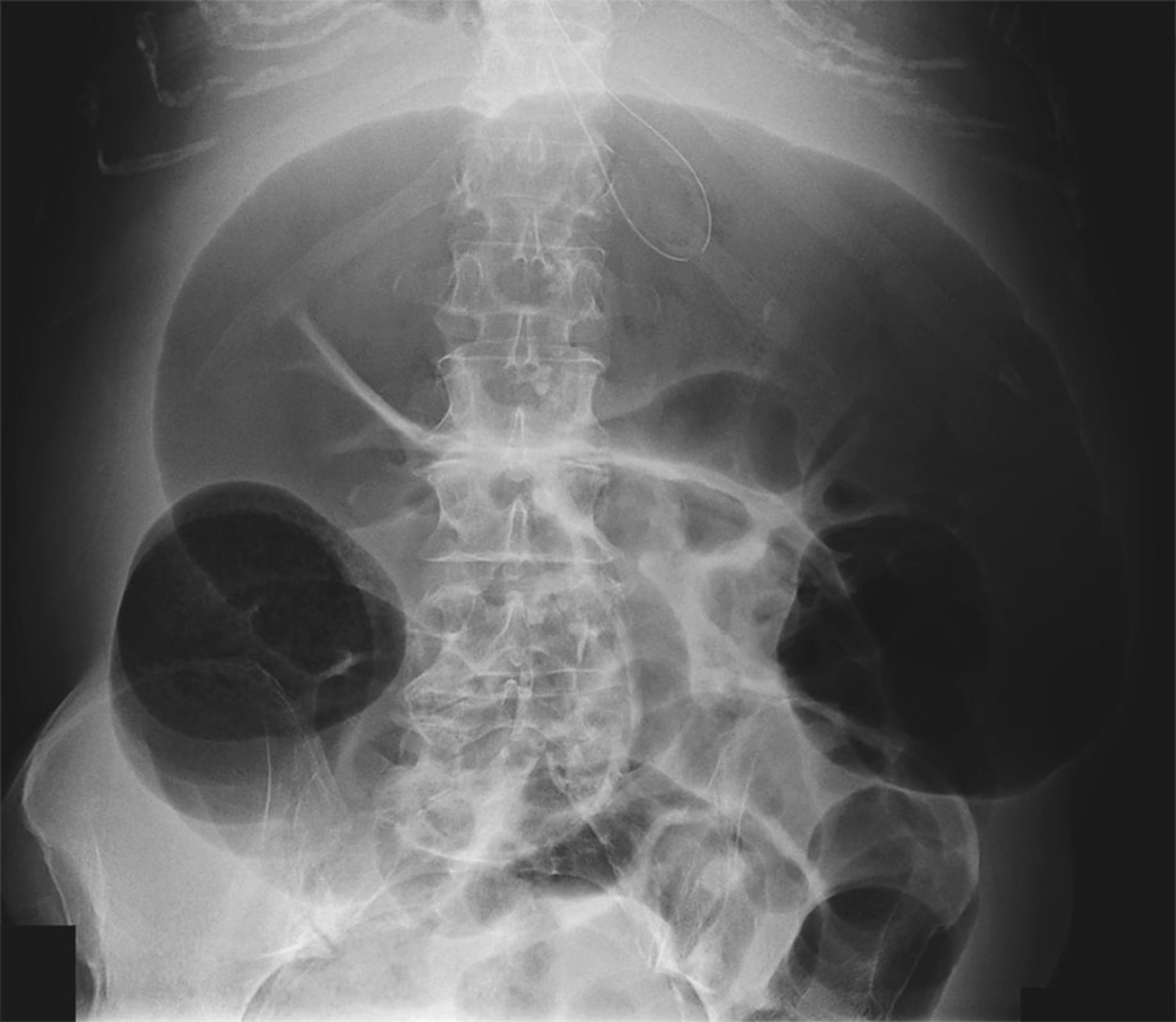 Ogilvie's syndrome