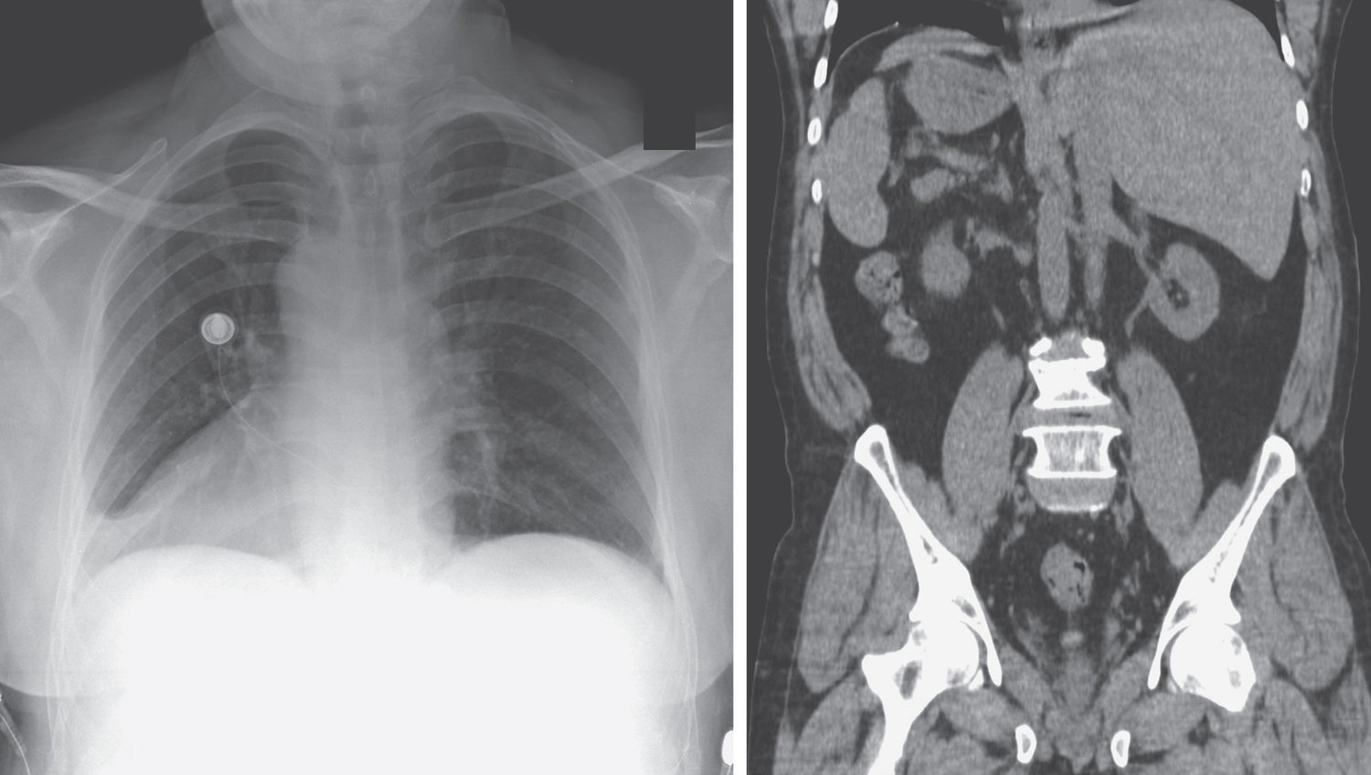 Situs inversus totalis