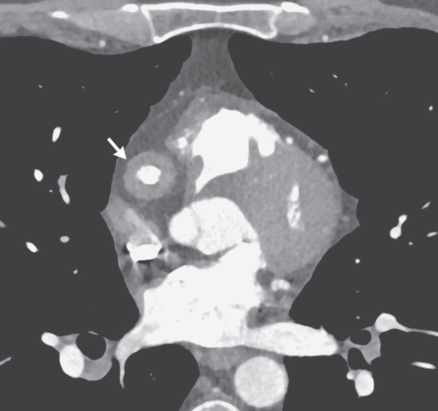 IgG4-related disease arteritis