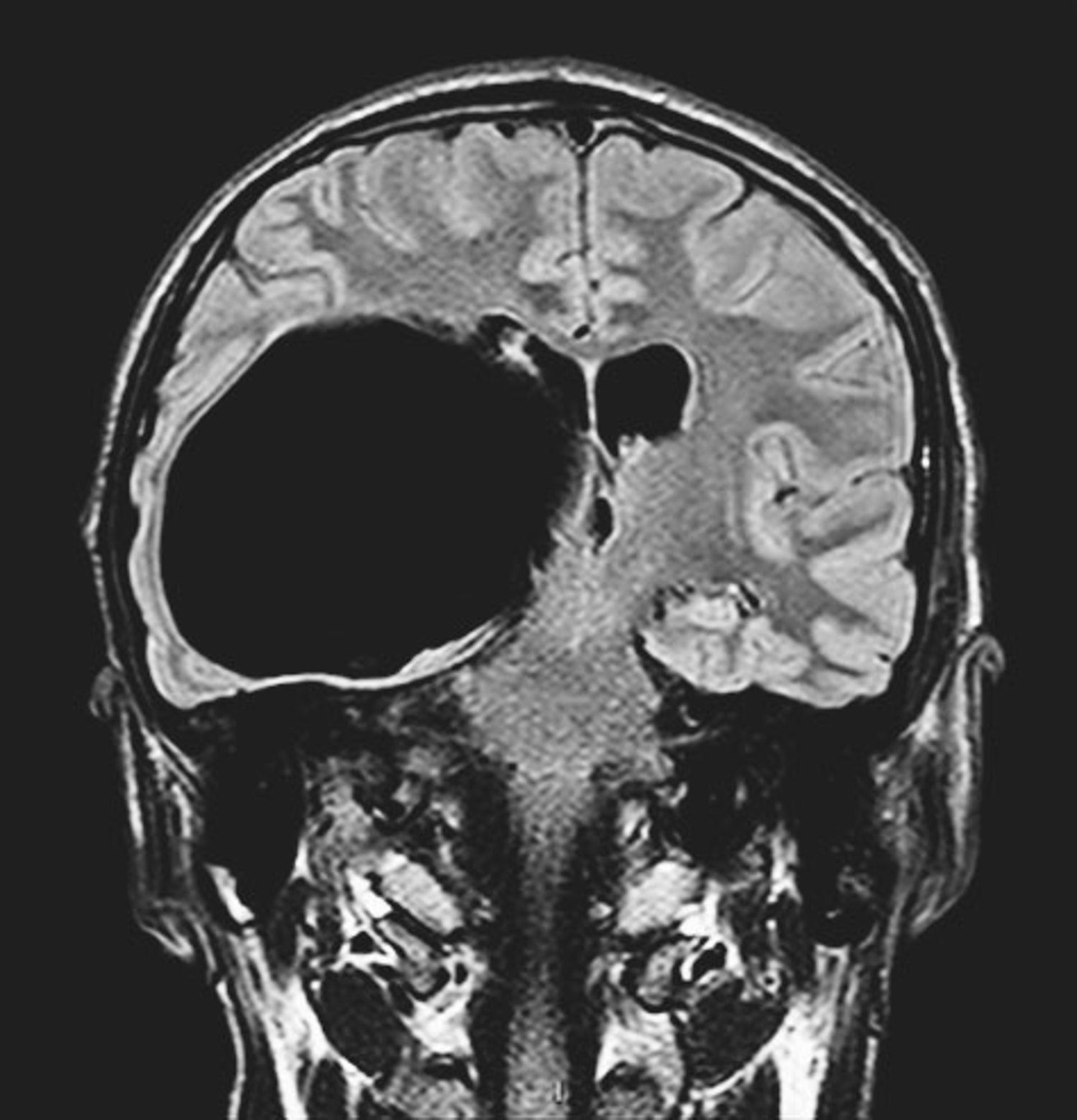 Arachnoid cyst