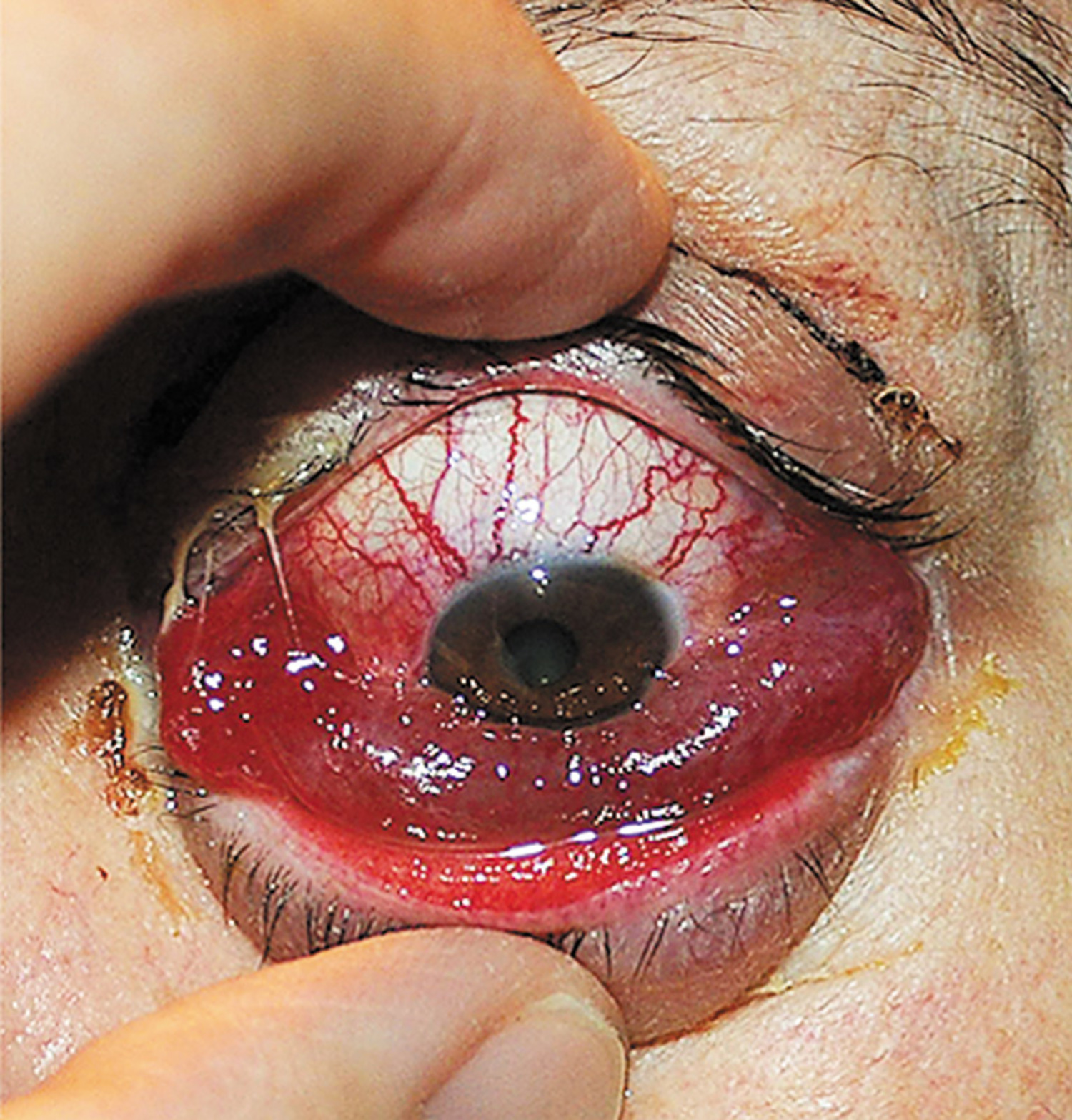 Carotid cavernous sinus fistula