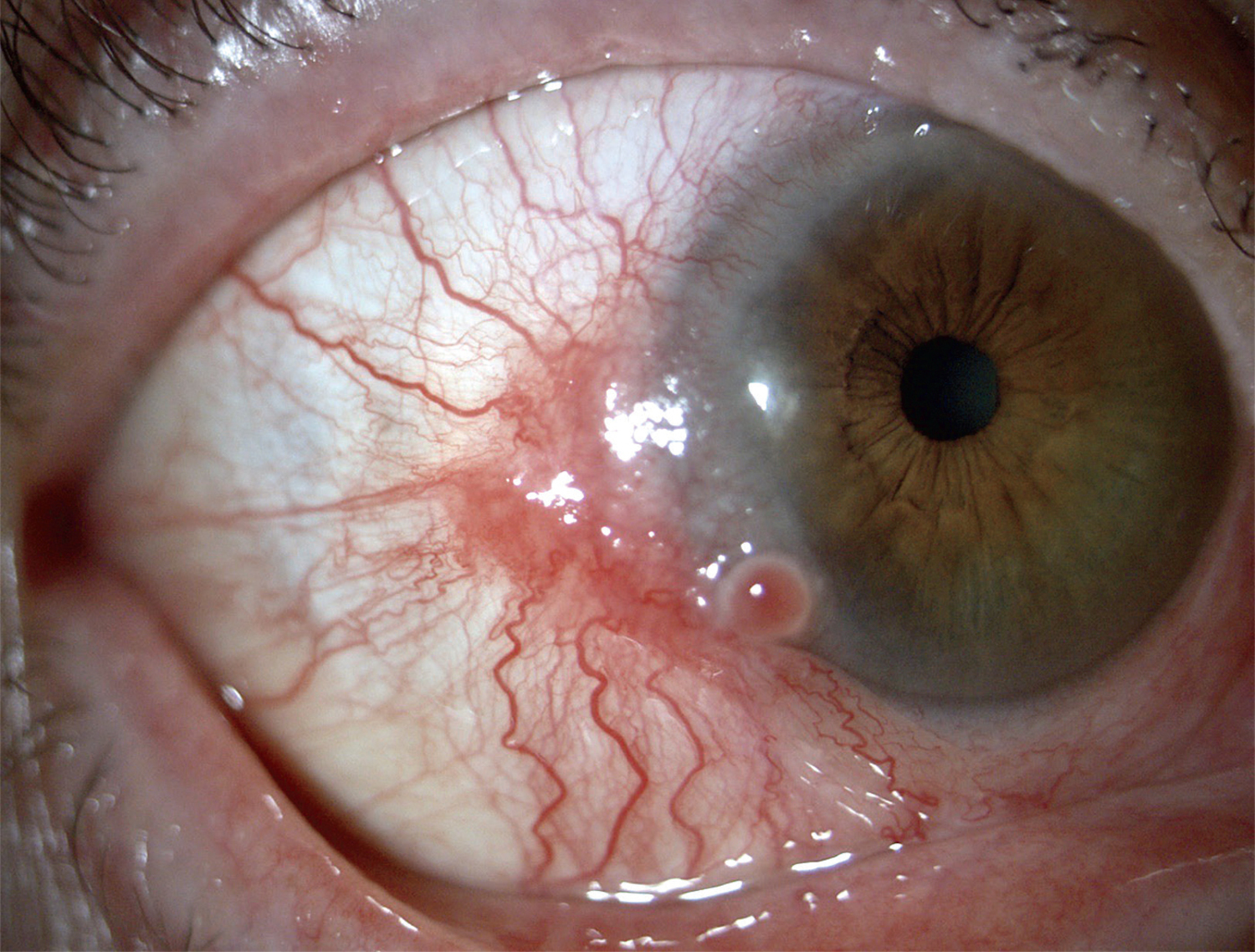 Conjunctival squamous-cell carcinoma