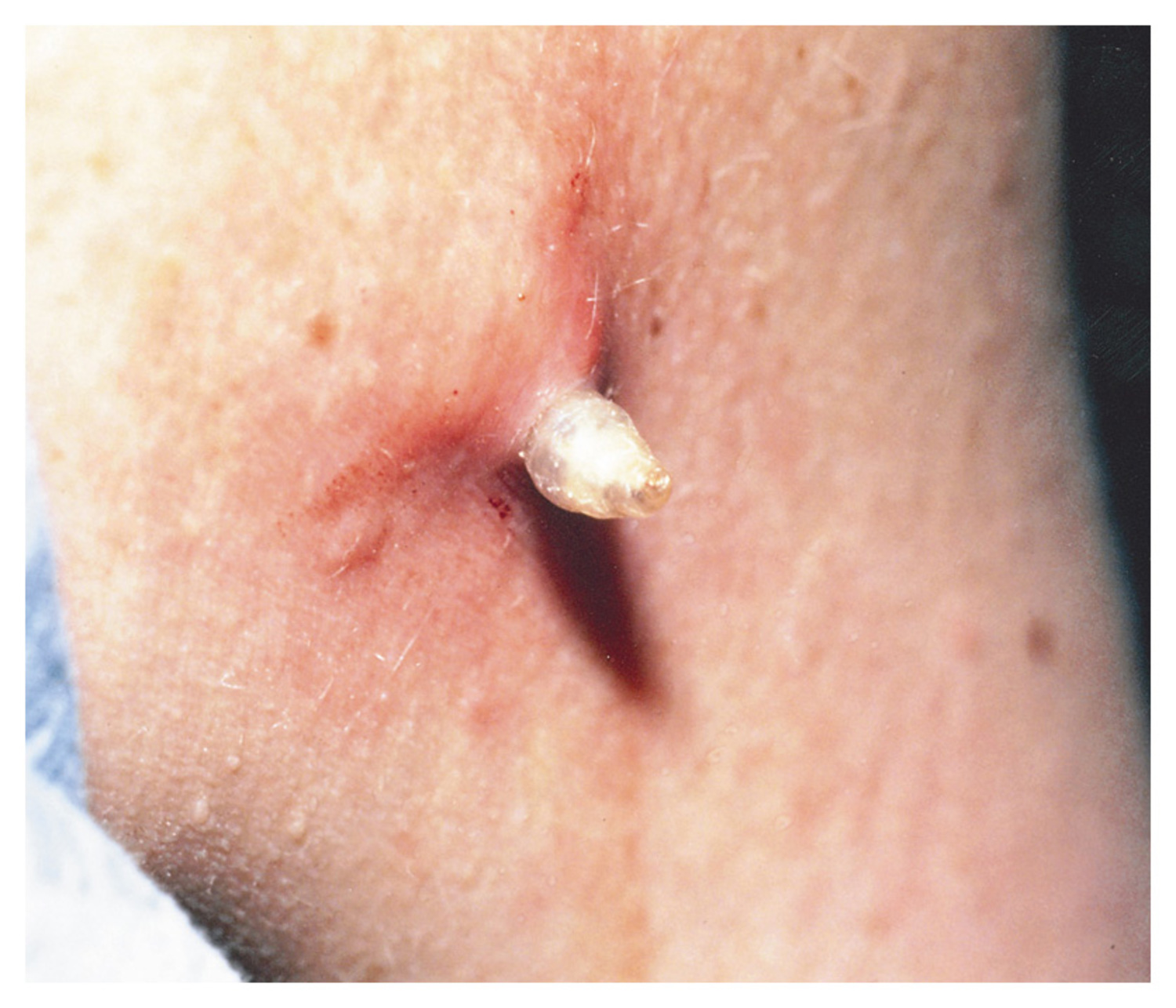 Furuncular myiasis