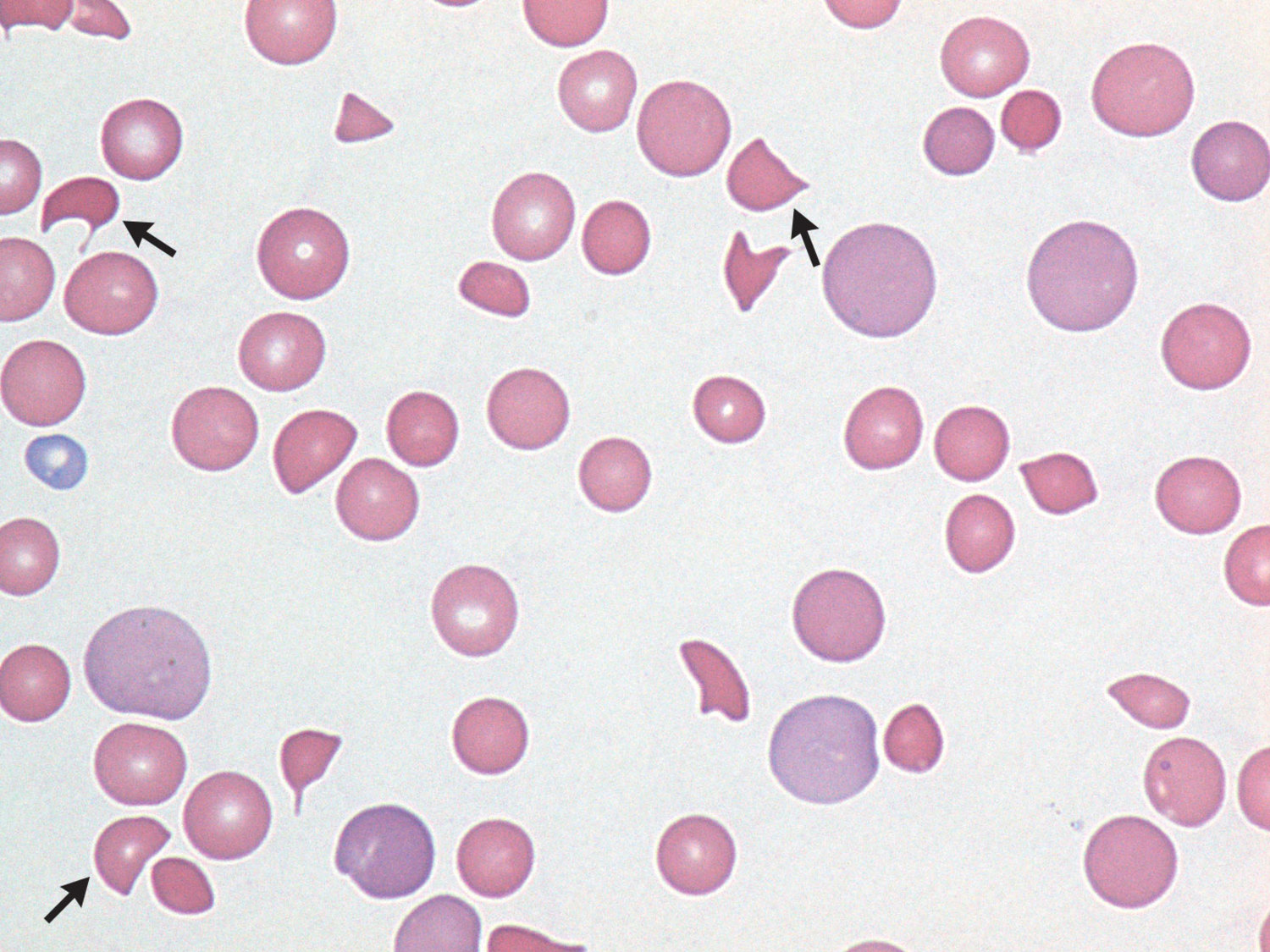 Thrombotic thrombocytopenic purpura