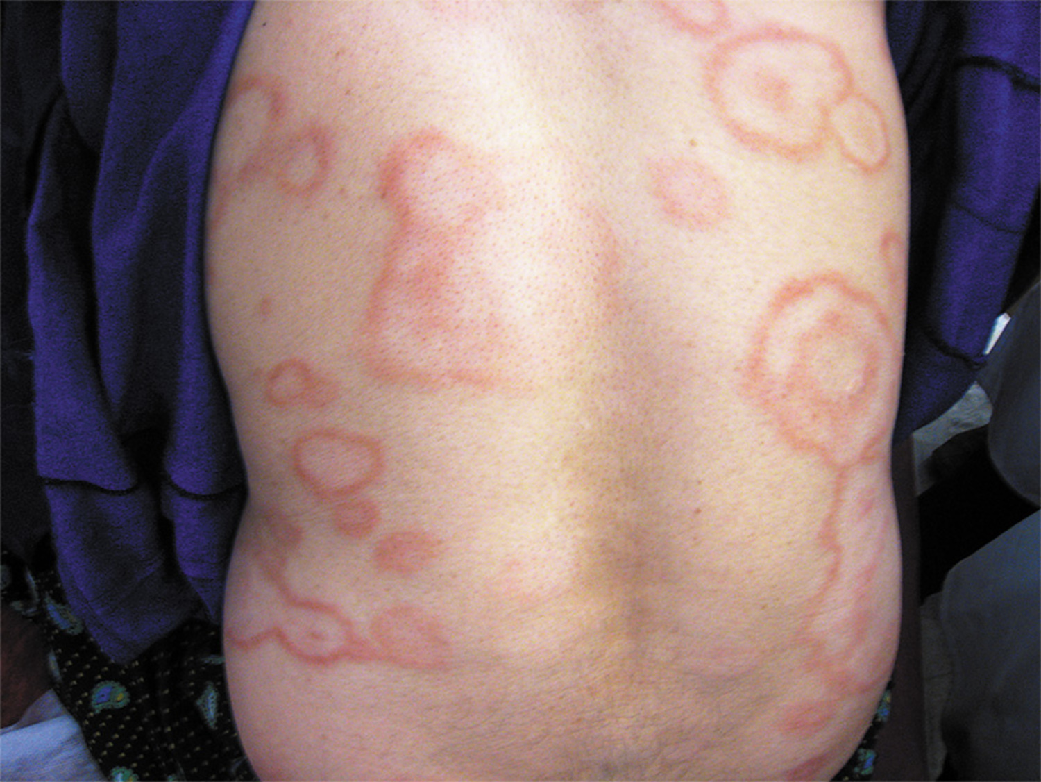 Tuberculoid leprosy