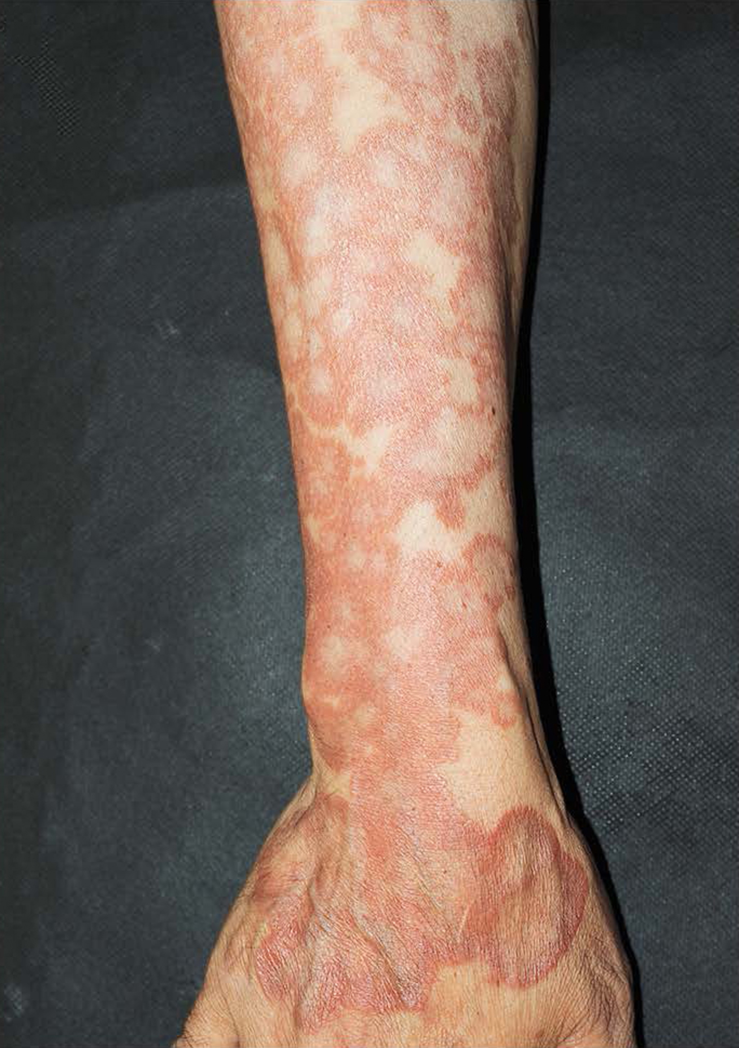 Generalized granuloma annulare