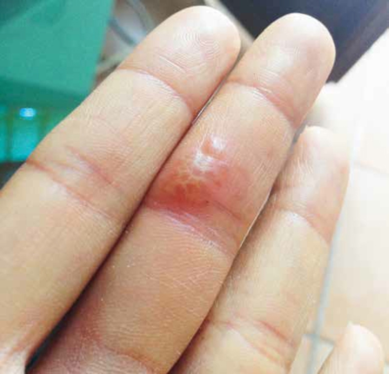 Herpetic whitlow