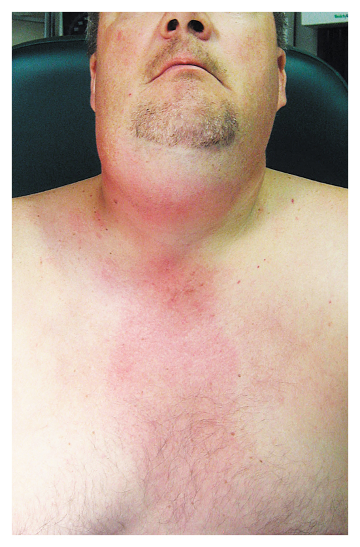 Ludwig's angina