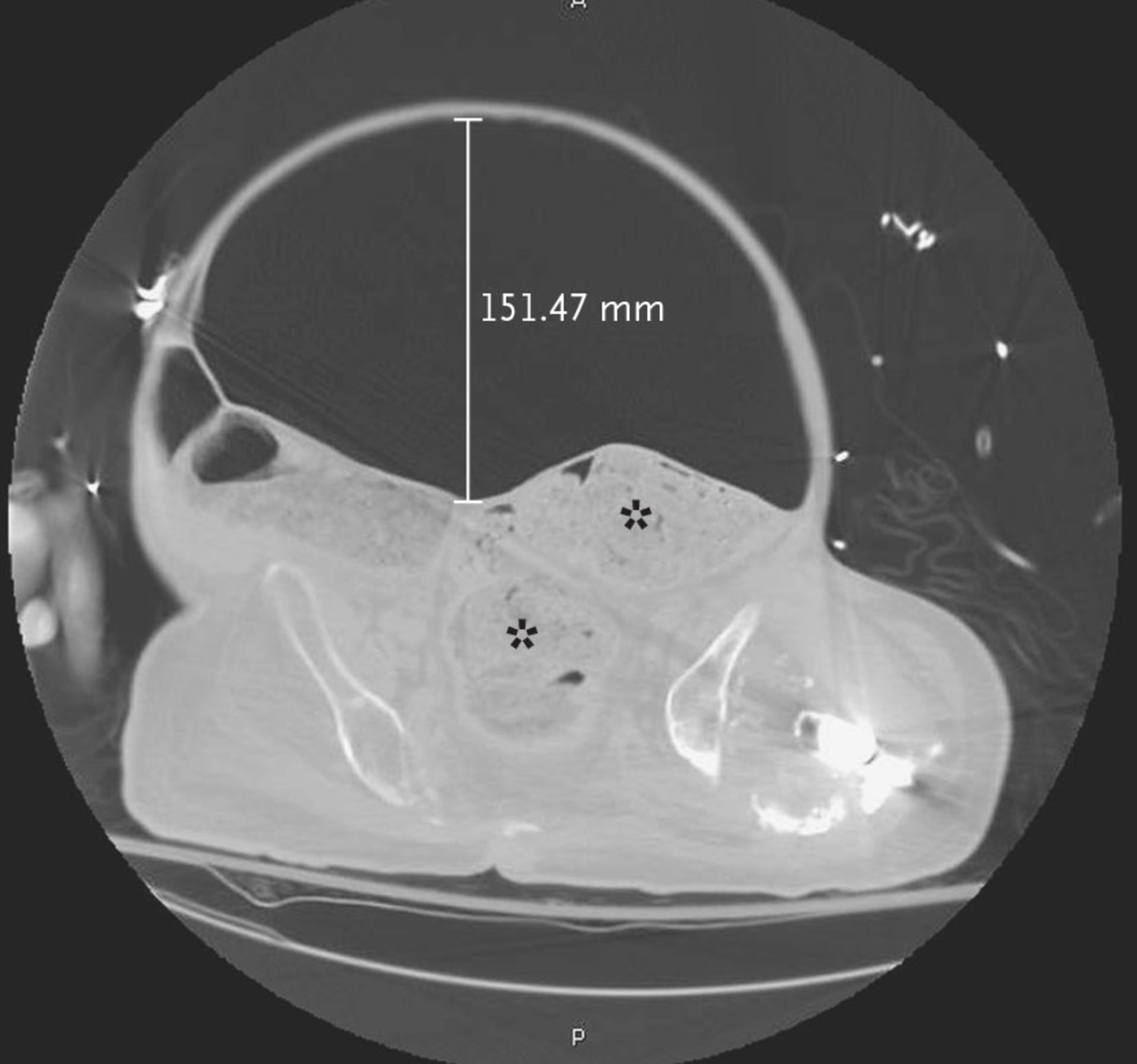 Neurogenic megacolon