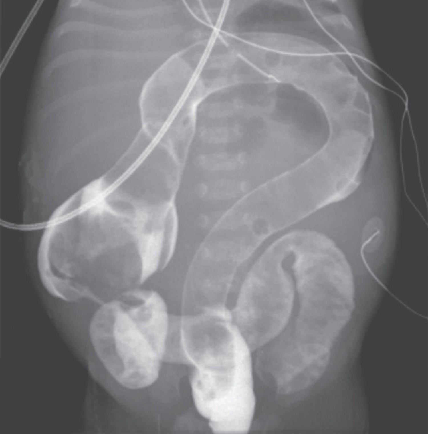 Hirschsprung's disease