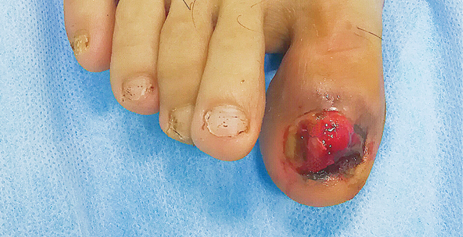Acral lentiginous melanoma