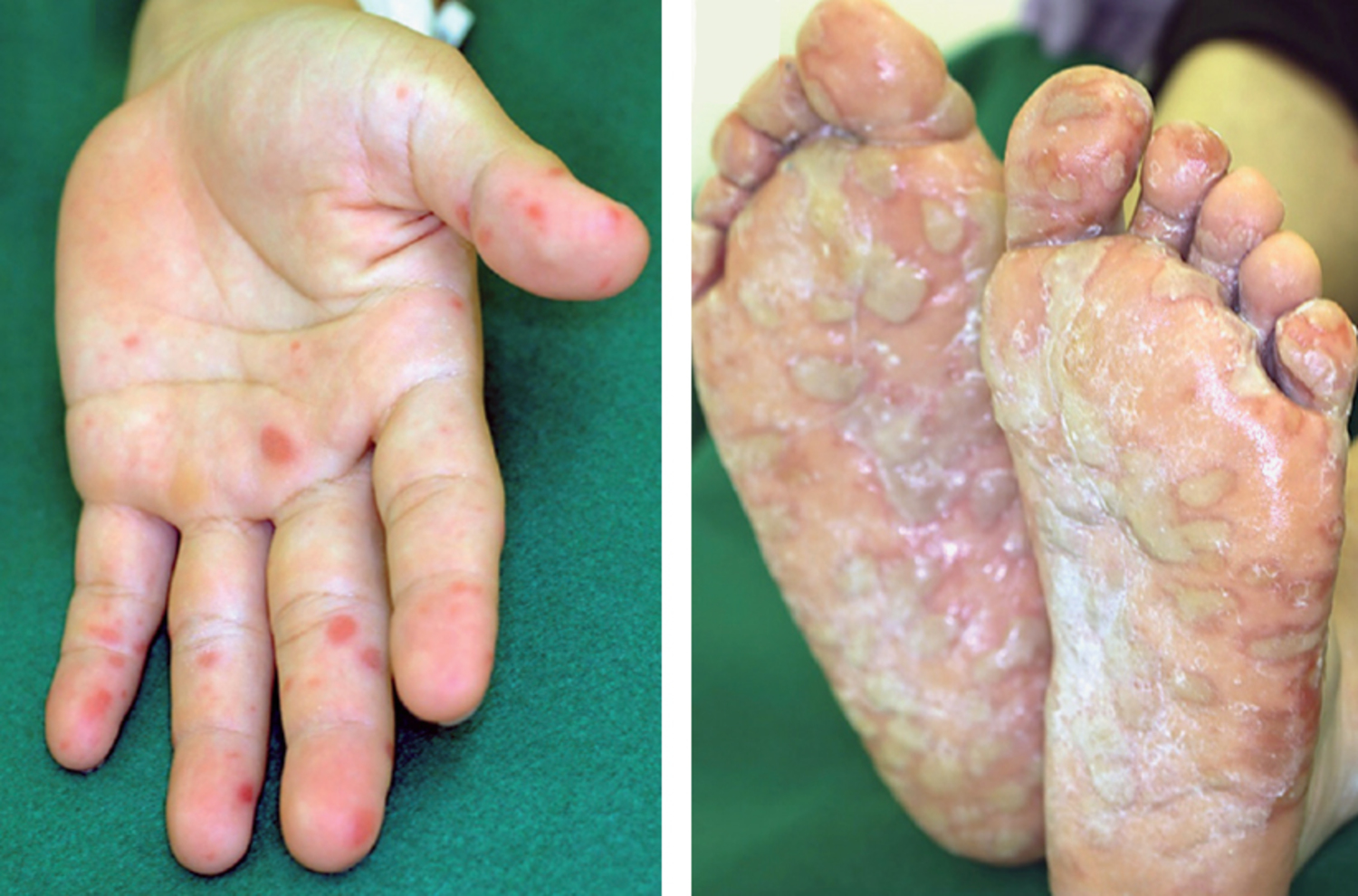 Hand, foot, and mouth disease