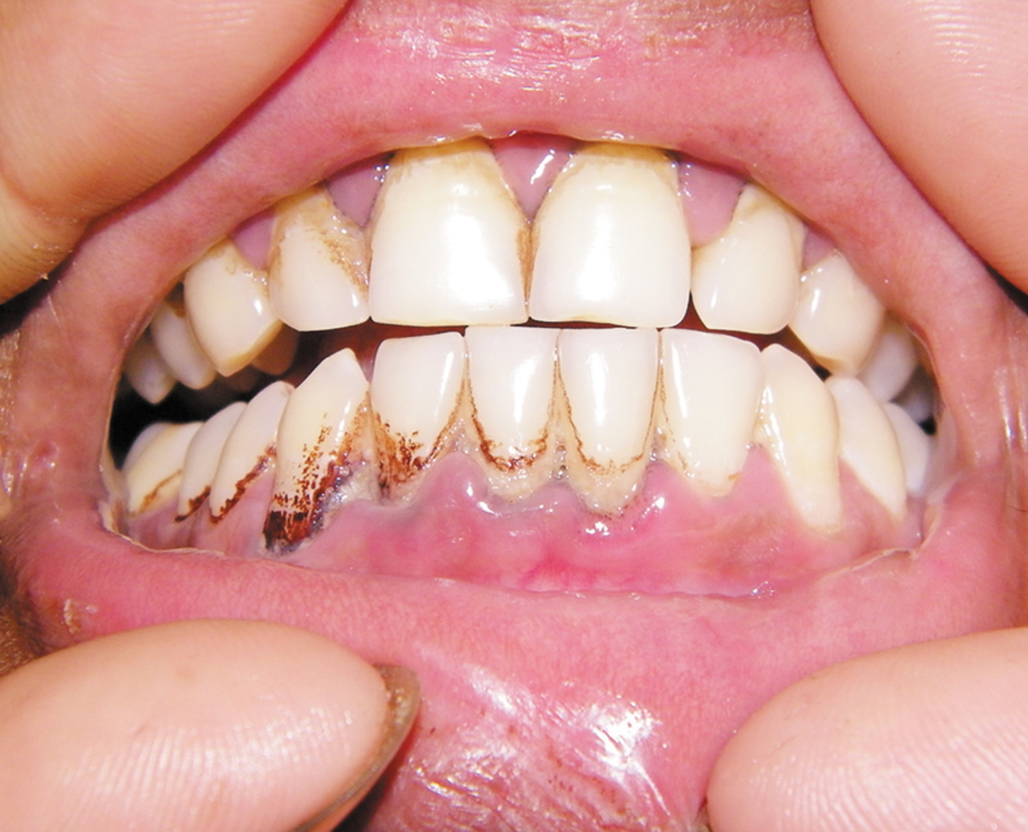 Lead poisoning