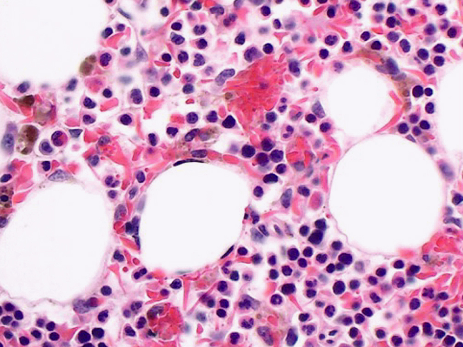Hemophagocytosis of sickle cells