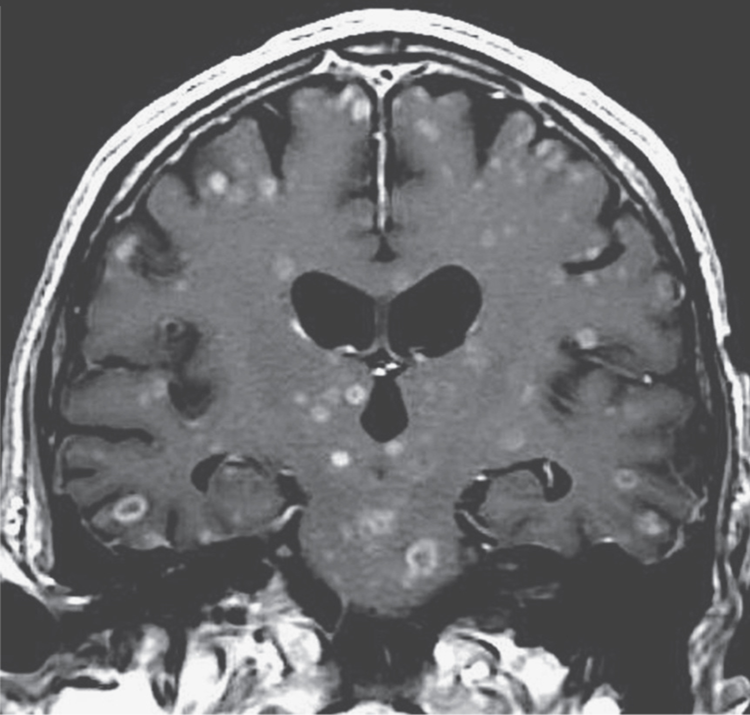 Metastatic adenocarcinoma