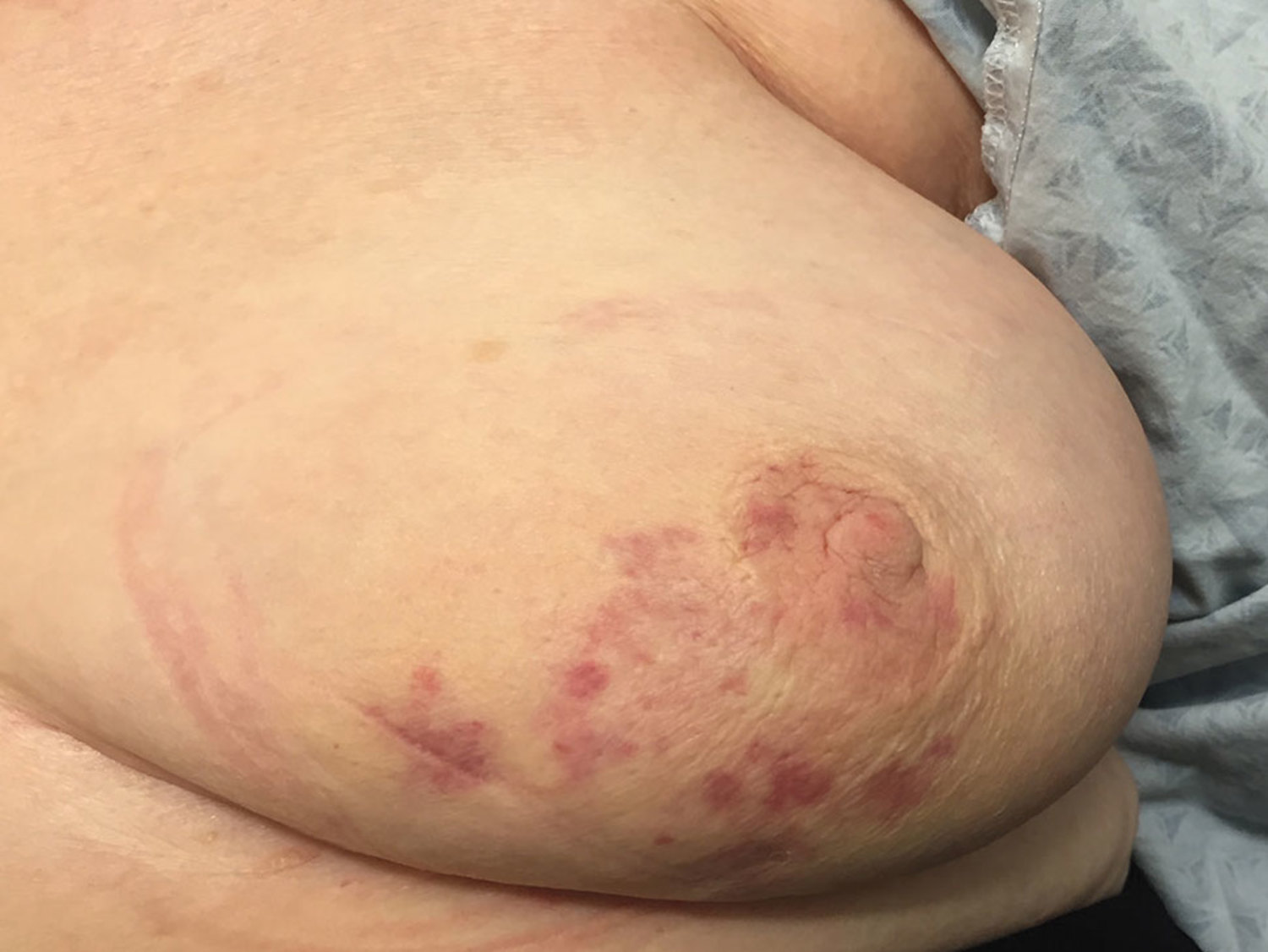 Radiation-induced angiosarcoma