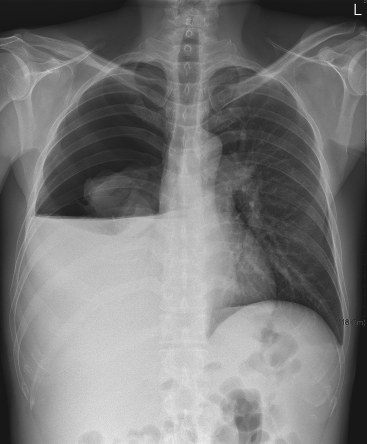 Hydropneumothorax