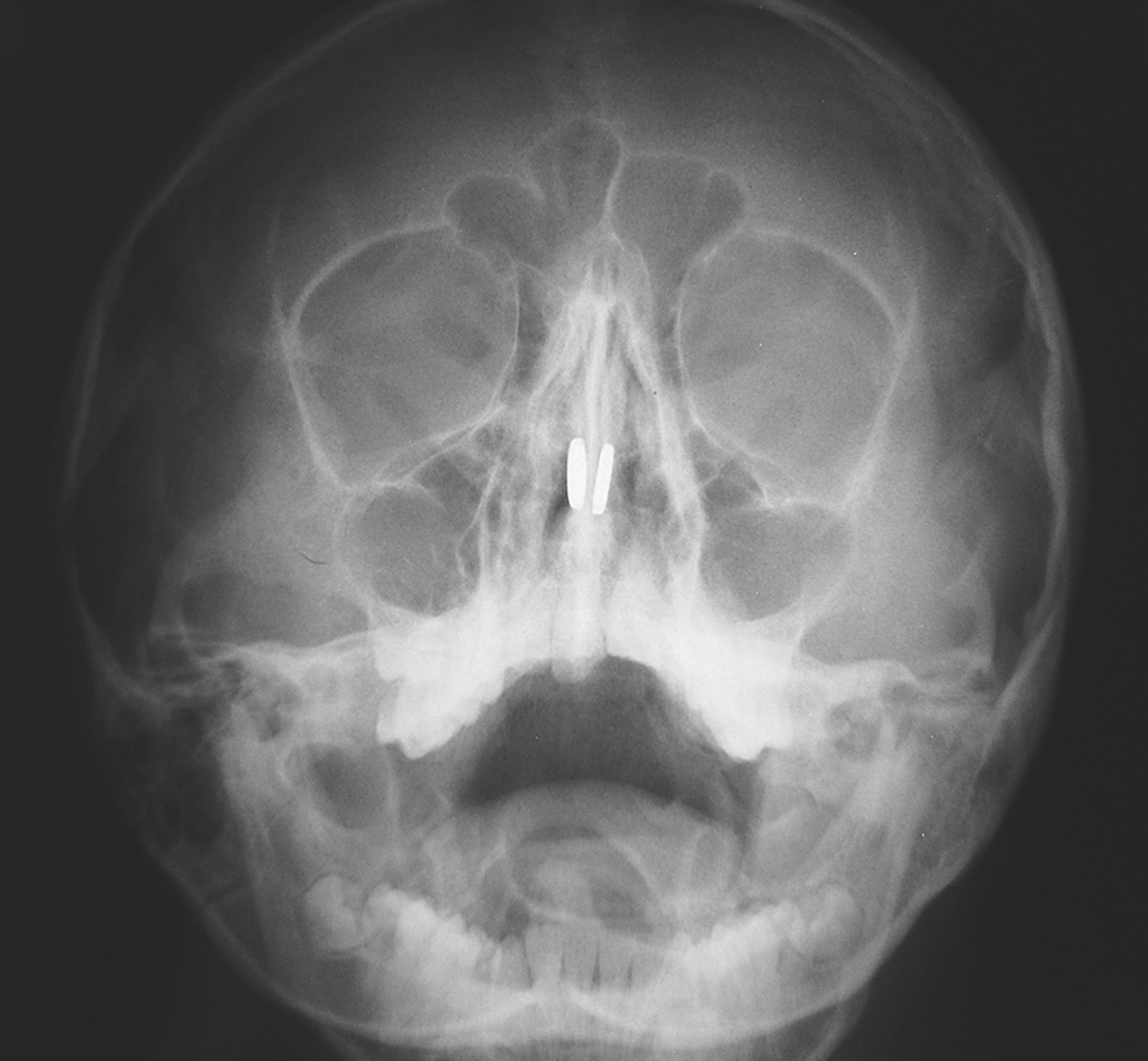 Button magnets in the nasal cavity