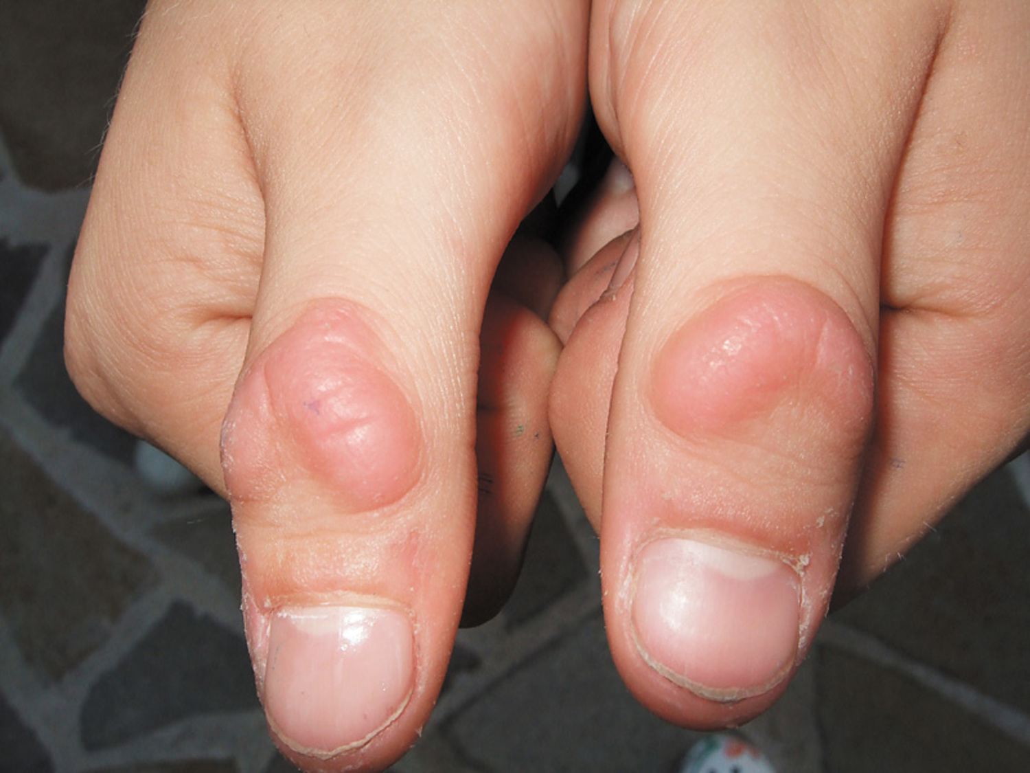 Bulimia nervosa