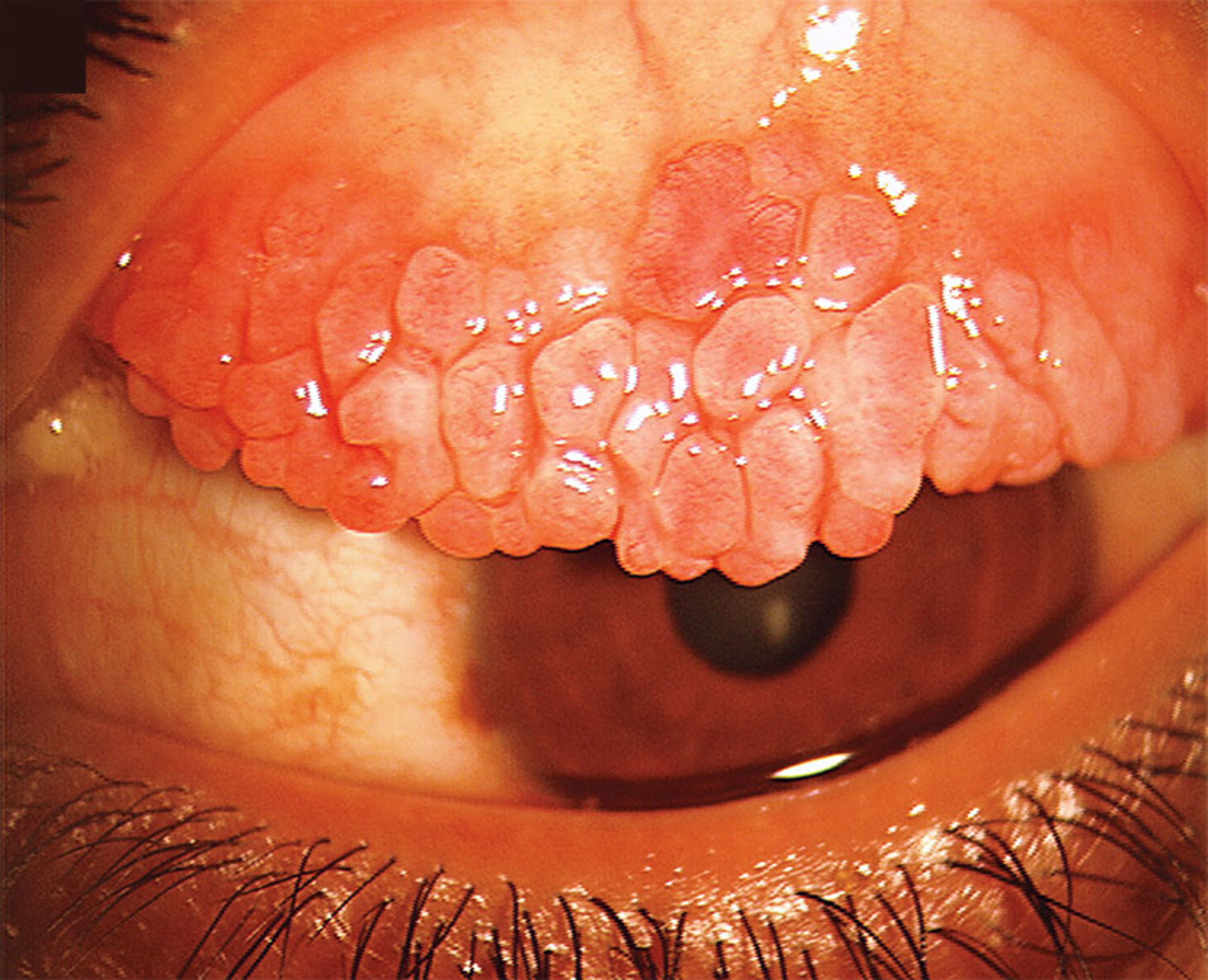 Vernal keratoconjunctivitis