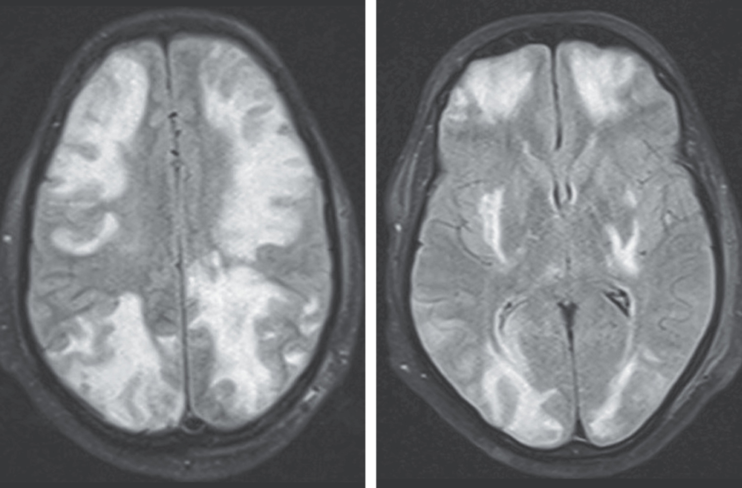 Posterior reversible encephalopathy syndrome