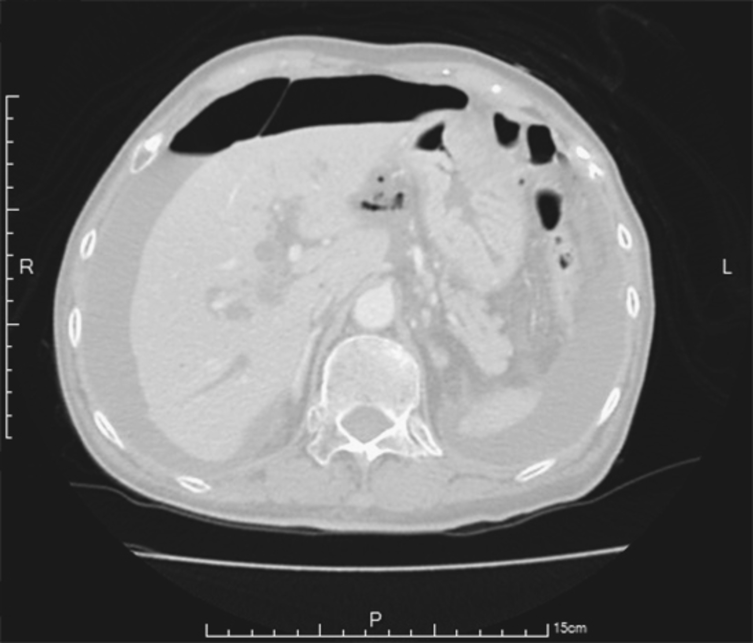 Falciform ligament