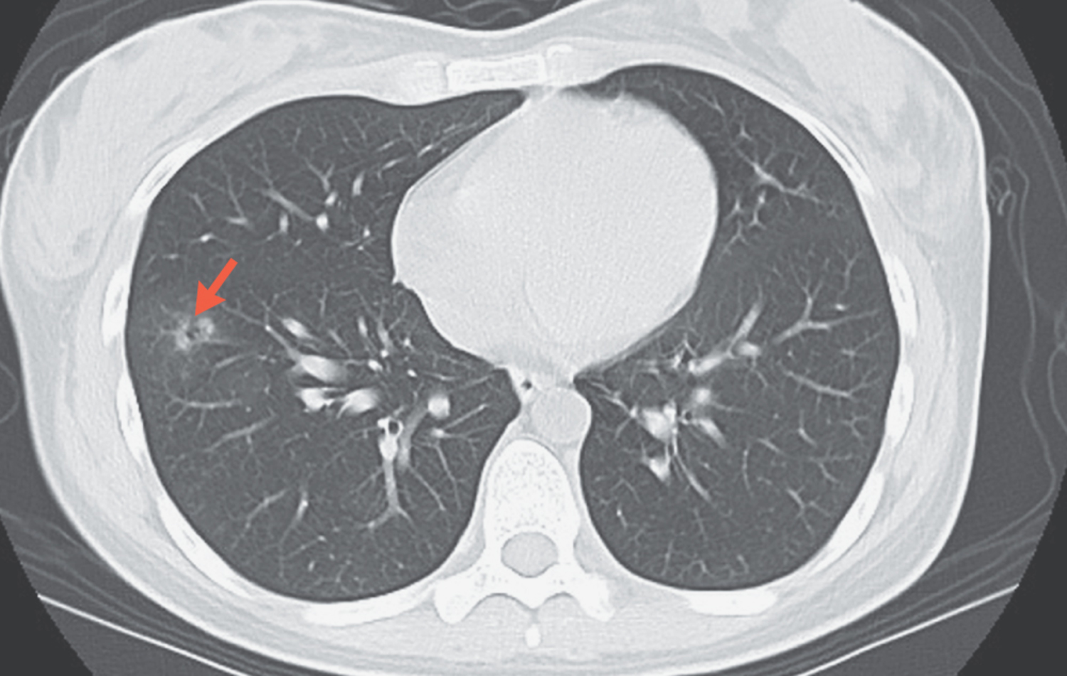 Thoracic endometriosis