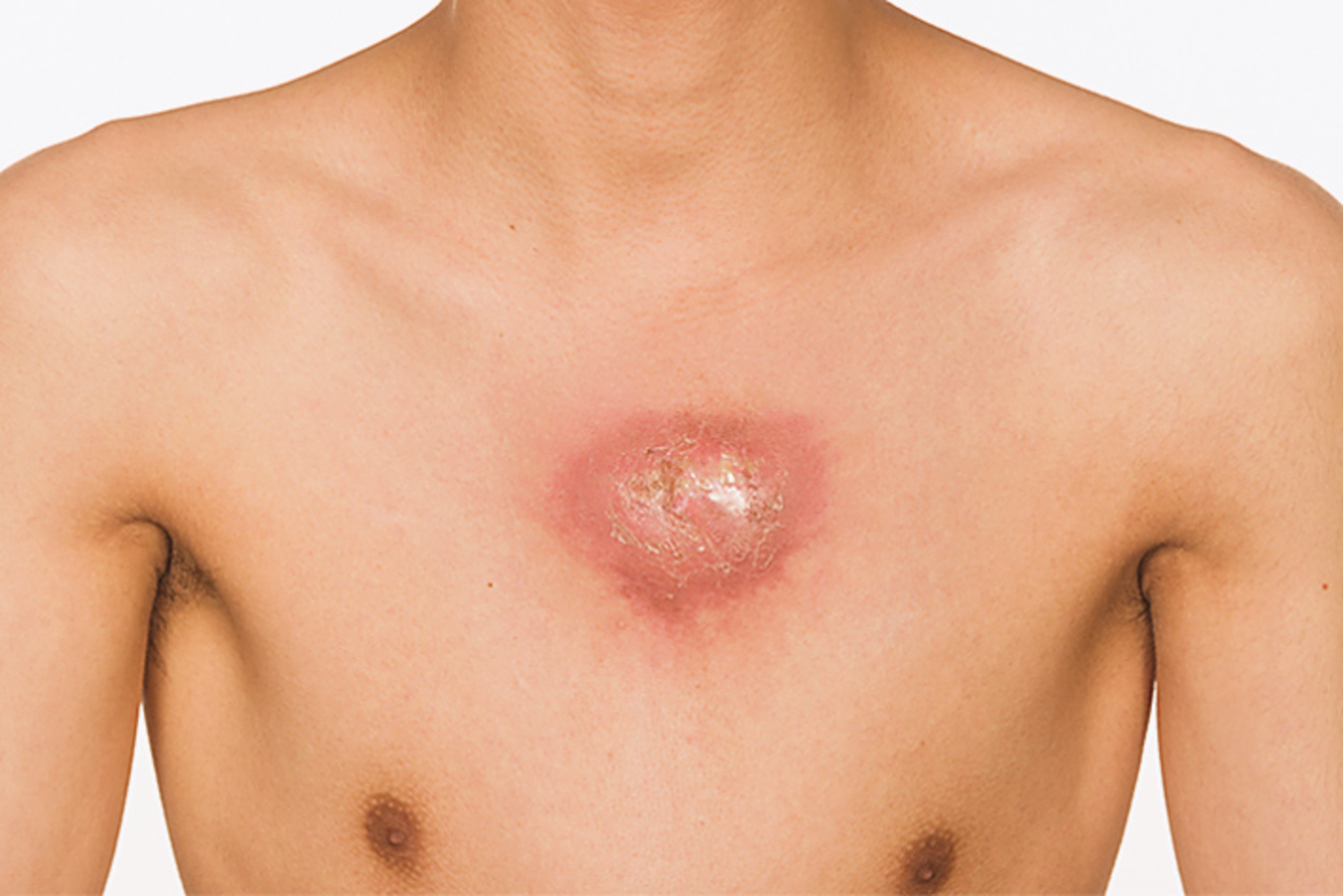 Tuberculosis