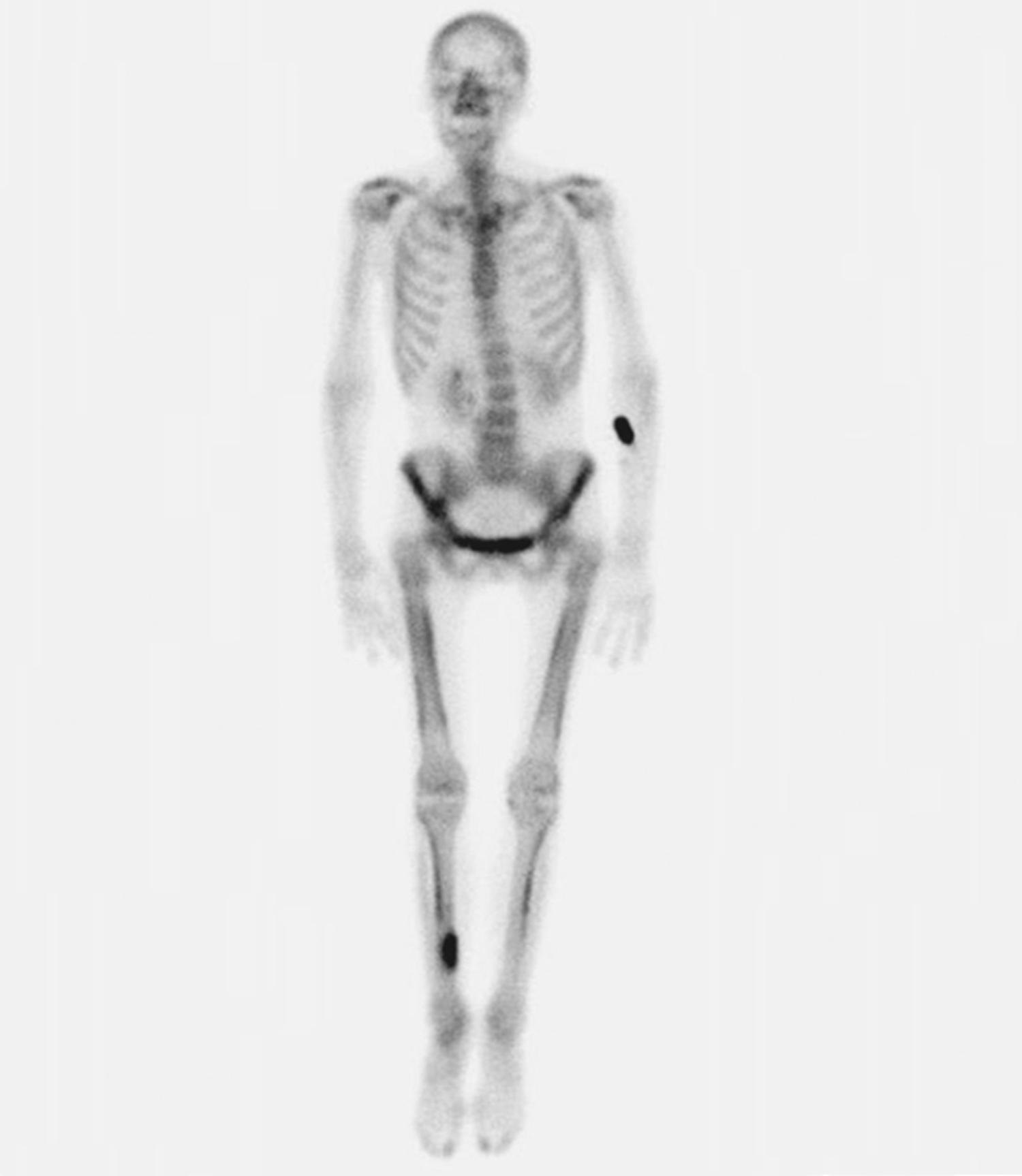Metastatic lung cancer