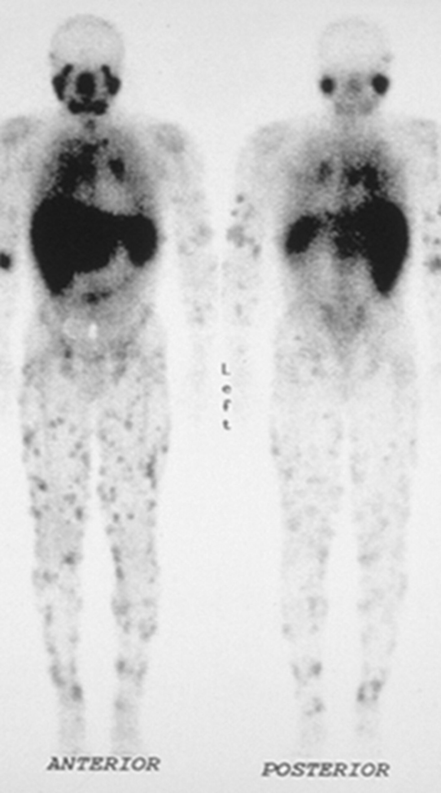 Sarcoidosis