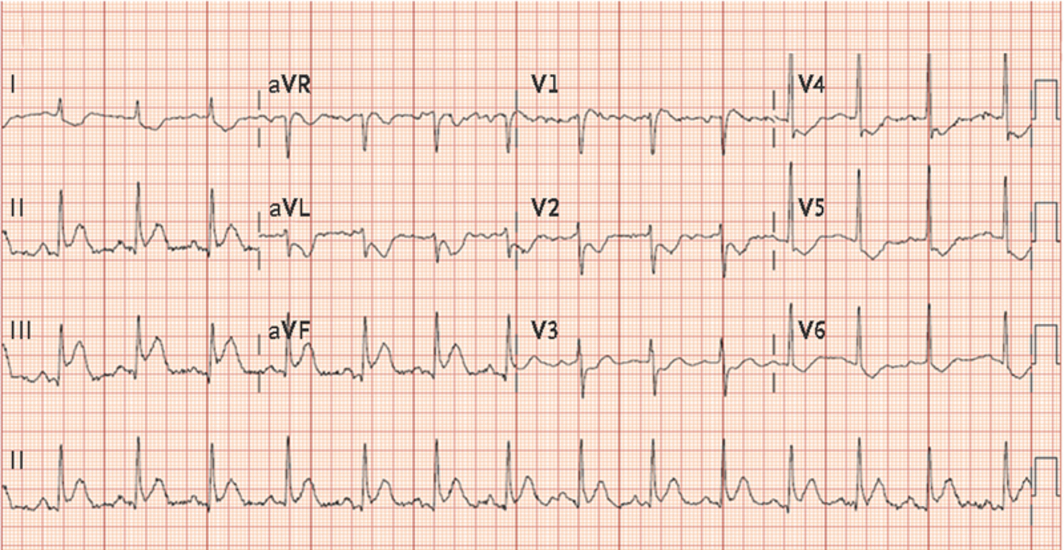 Right coronary artery occlusion