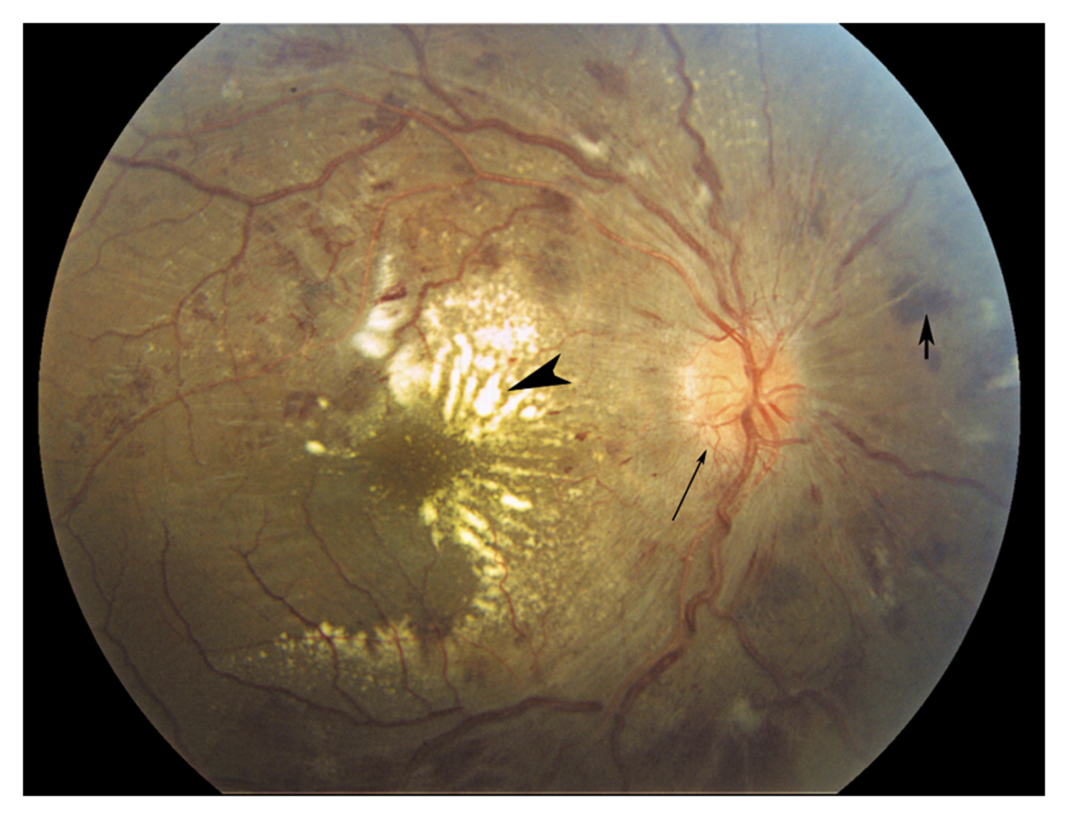 Malignant hypertension