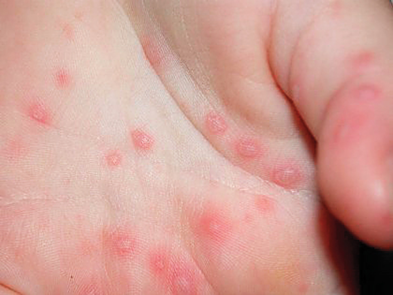 Coxsackie virus type A16