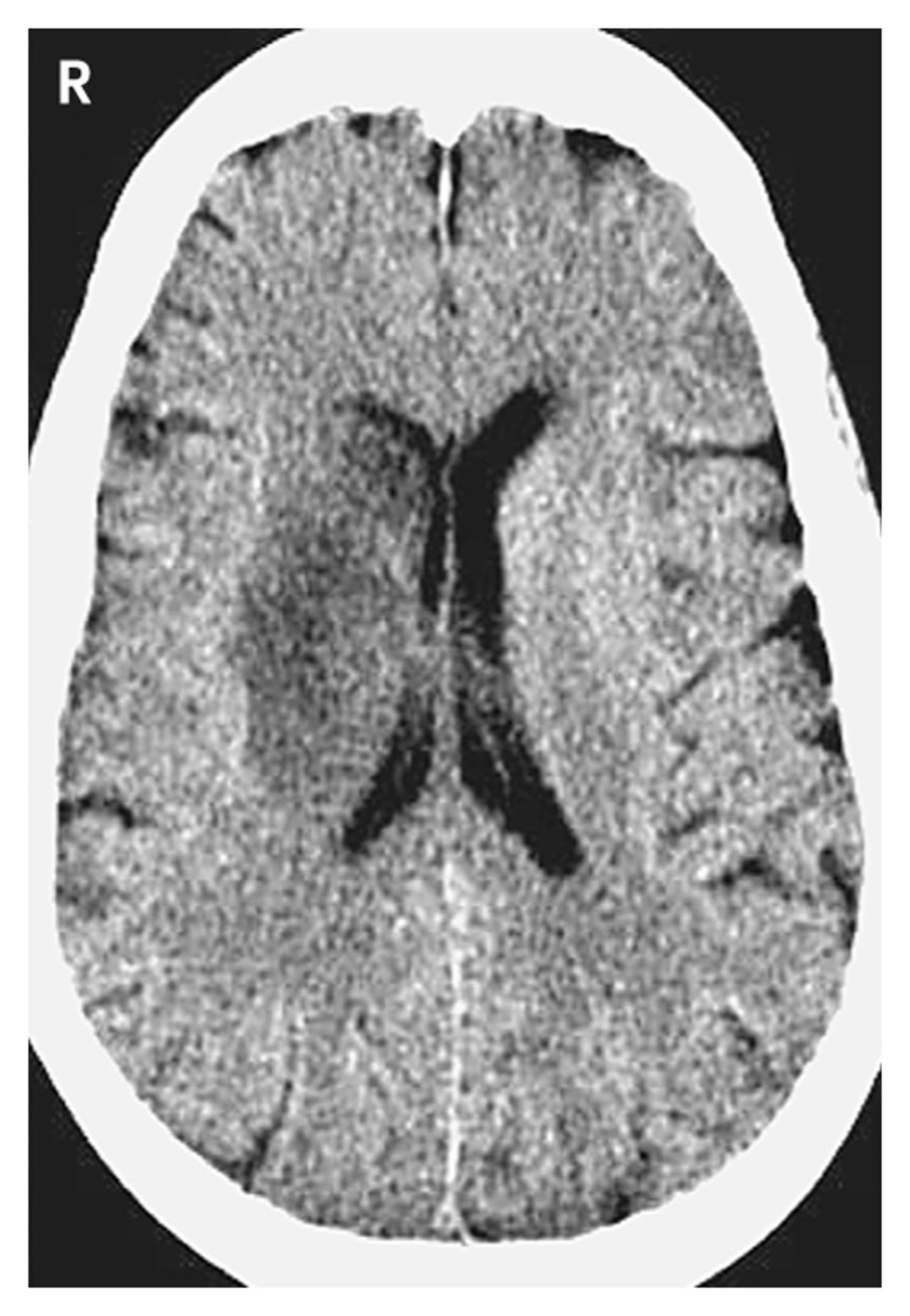 Left hemiparesis, gaze deviated to the right