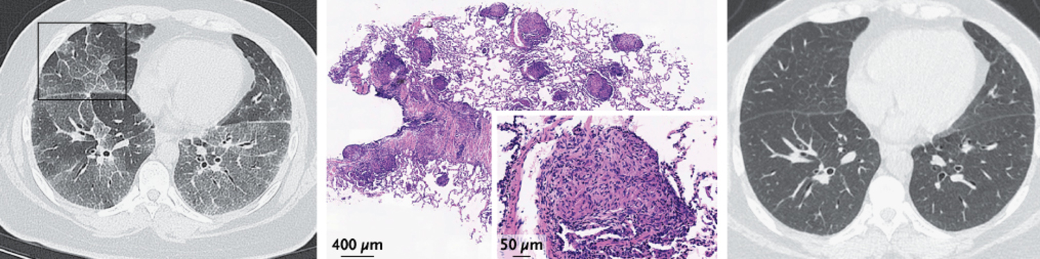 Pulmonary Sarcoidosis