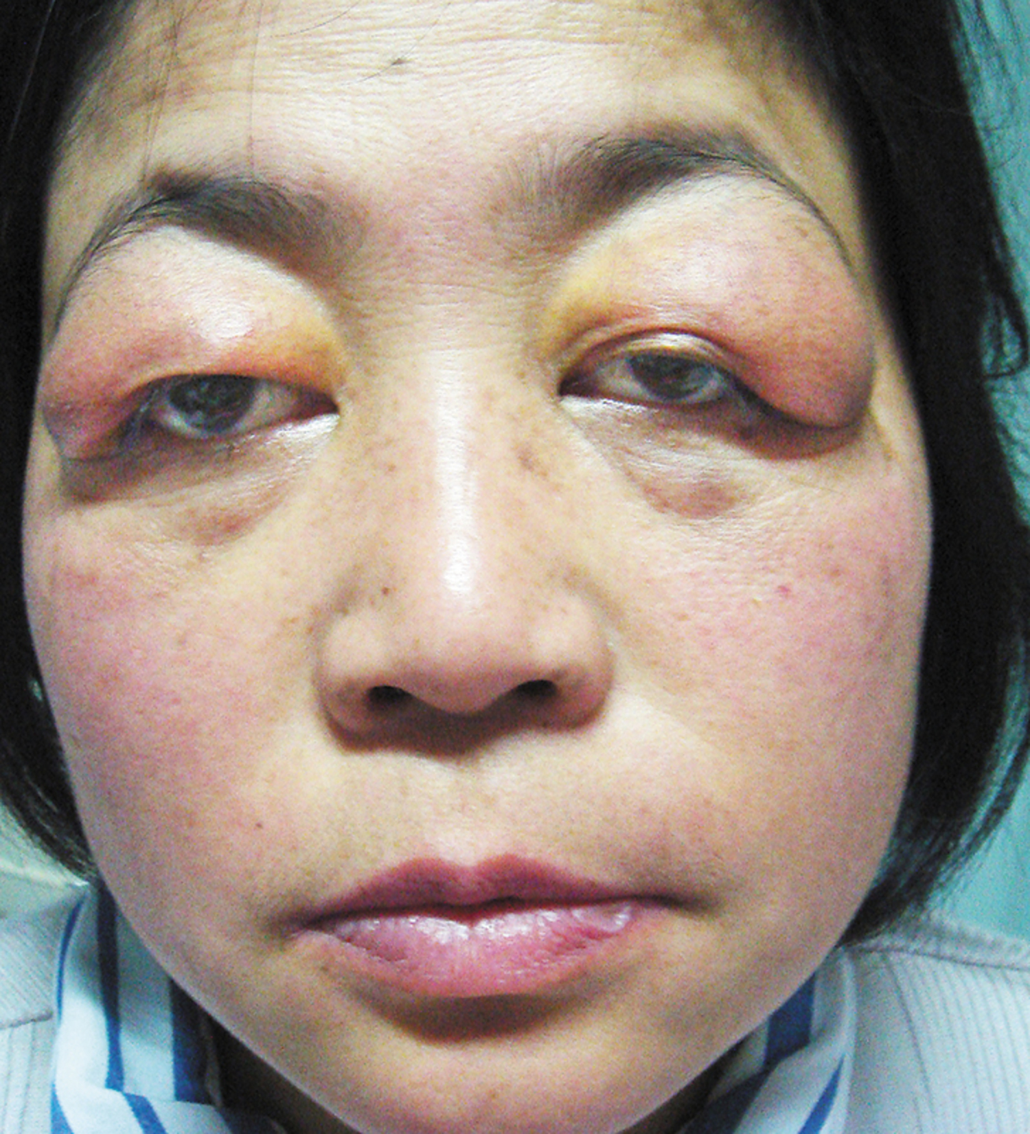 Sjögren's syndrome