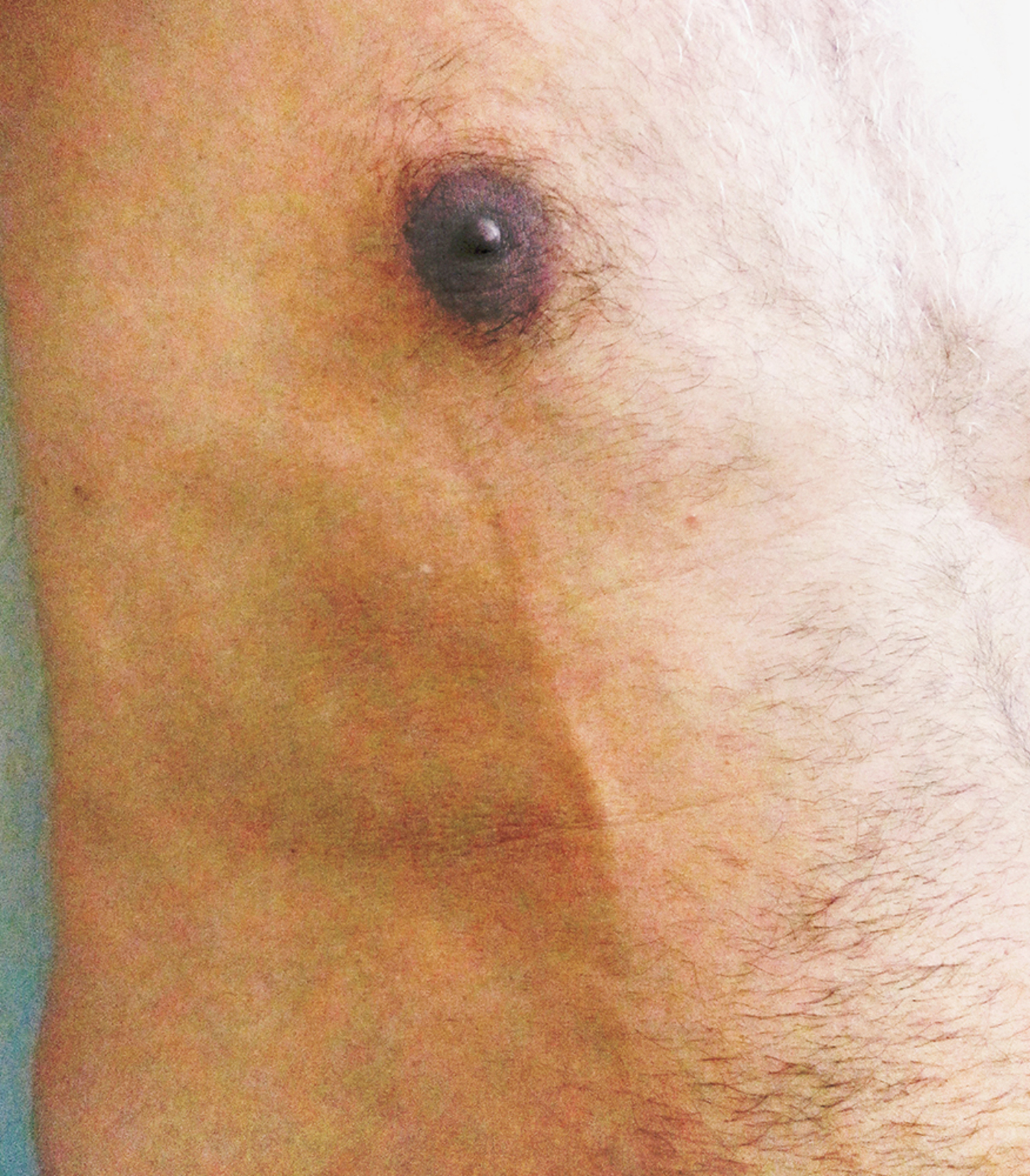Mondor's disease