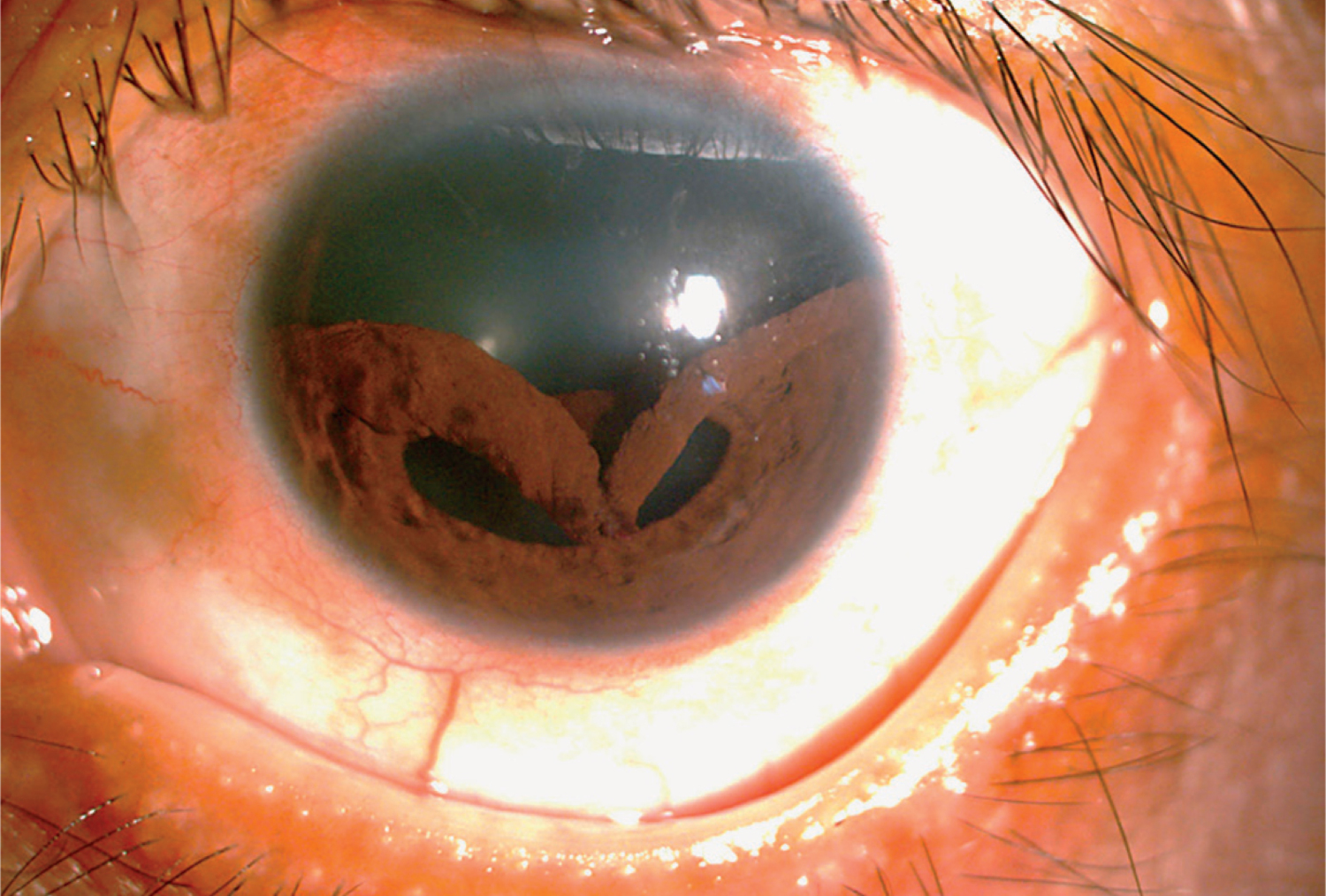 Separation of the iris