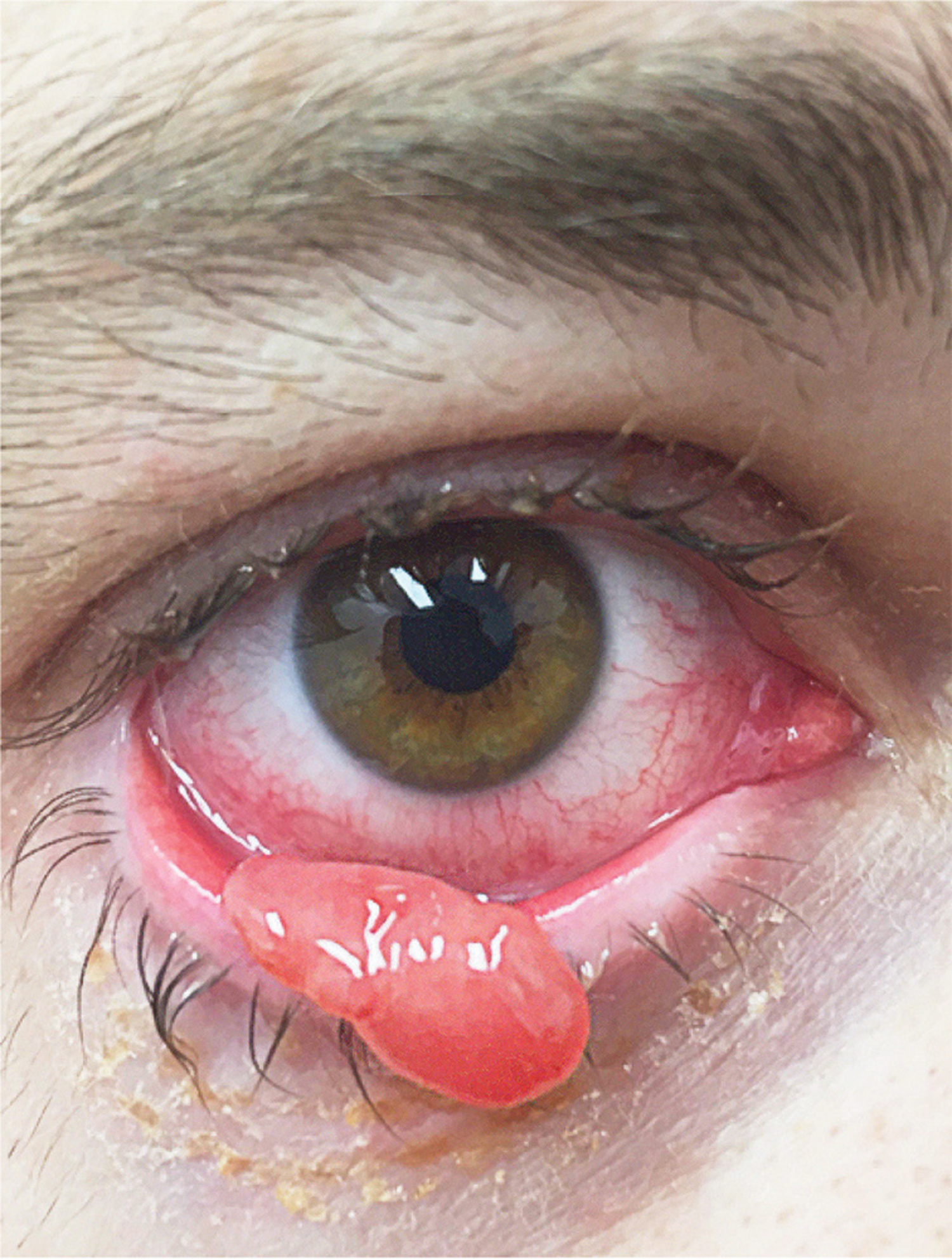 Pyogenic granuloma