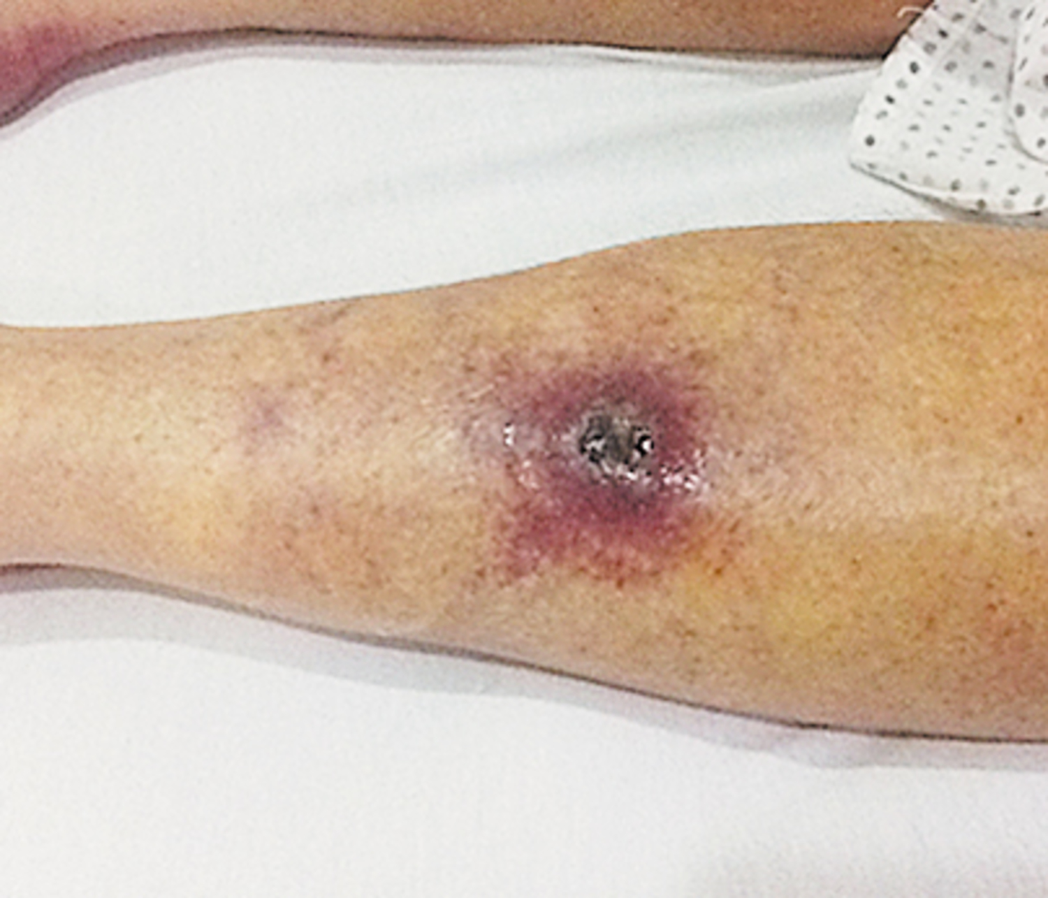 Trypanosomiasis